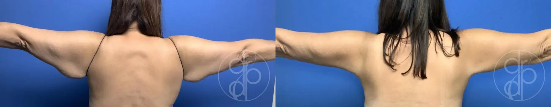 Brachioplasty: Patient 3 - Before and After 1