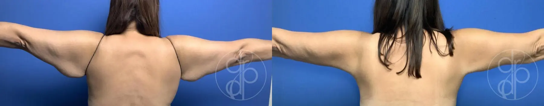 patient 11937 brachioplasty before and after result - Before and After