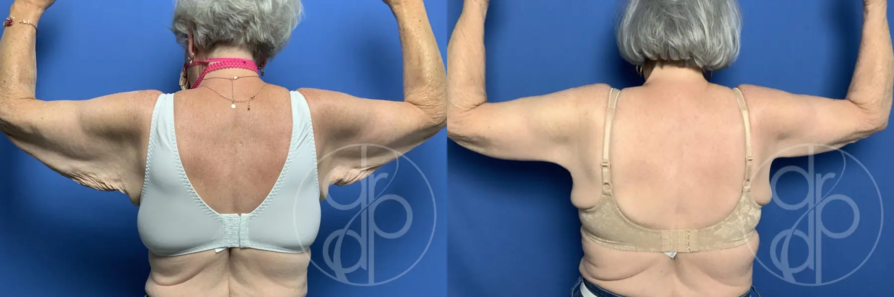 patient 12090 brachioplasty before and after result - Before and After
