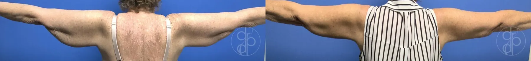 patient 13426 brachioplasty before and after result - Before and After 3