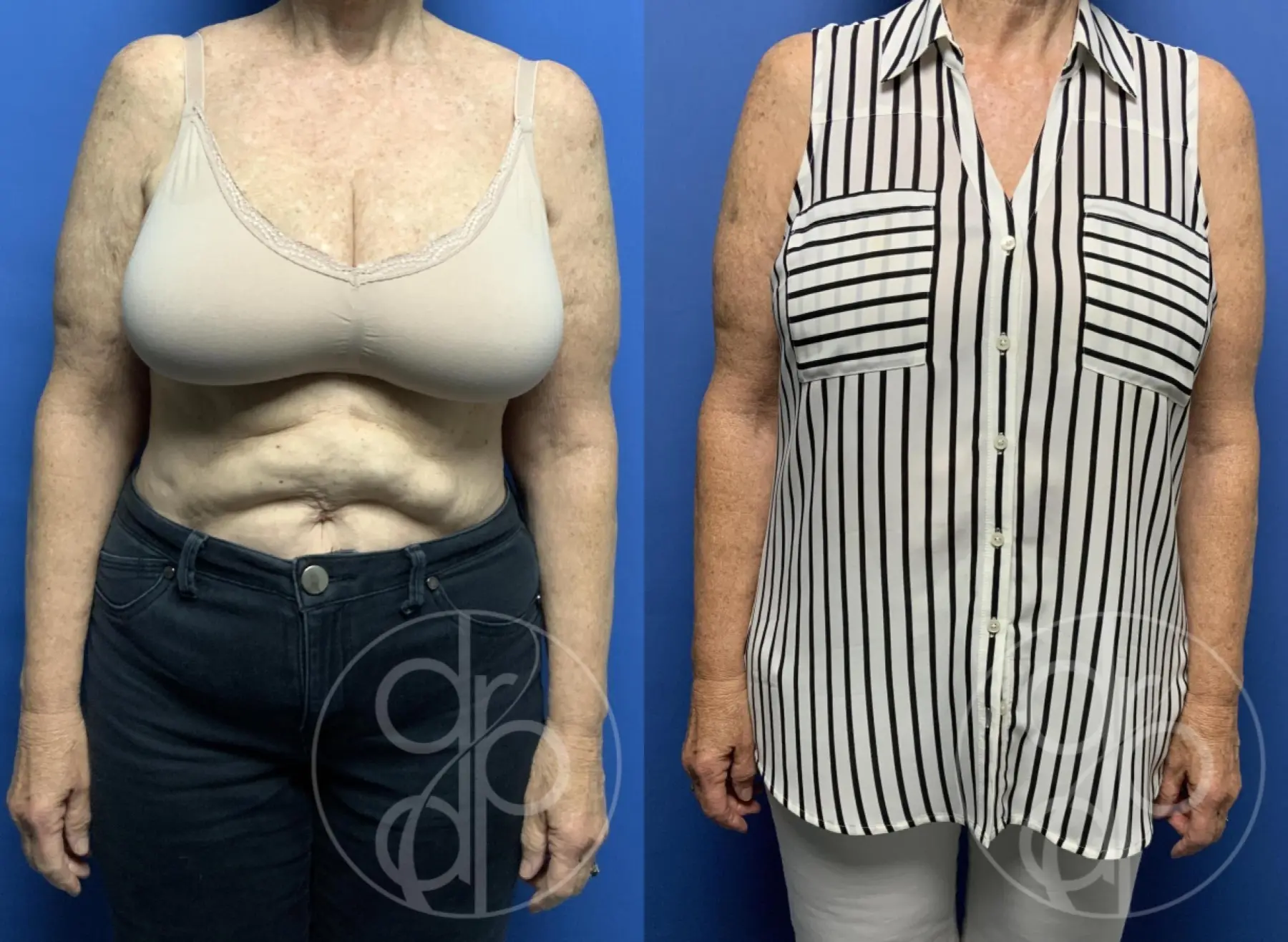 patient 13426 brachioplasty before and after result - Before and After