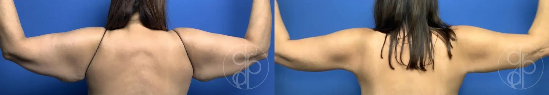 Brachioplasty: Patient 3 - Before and After 2