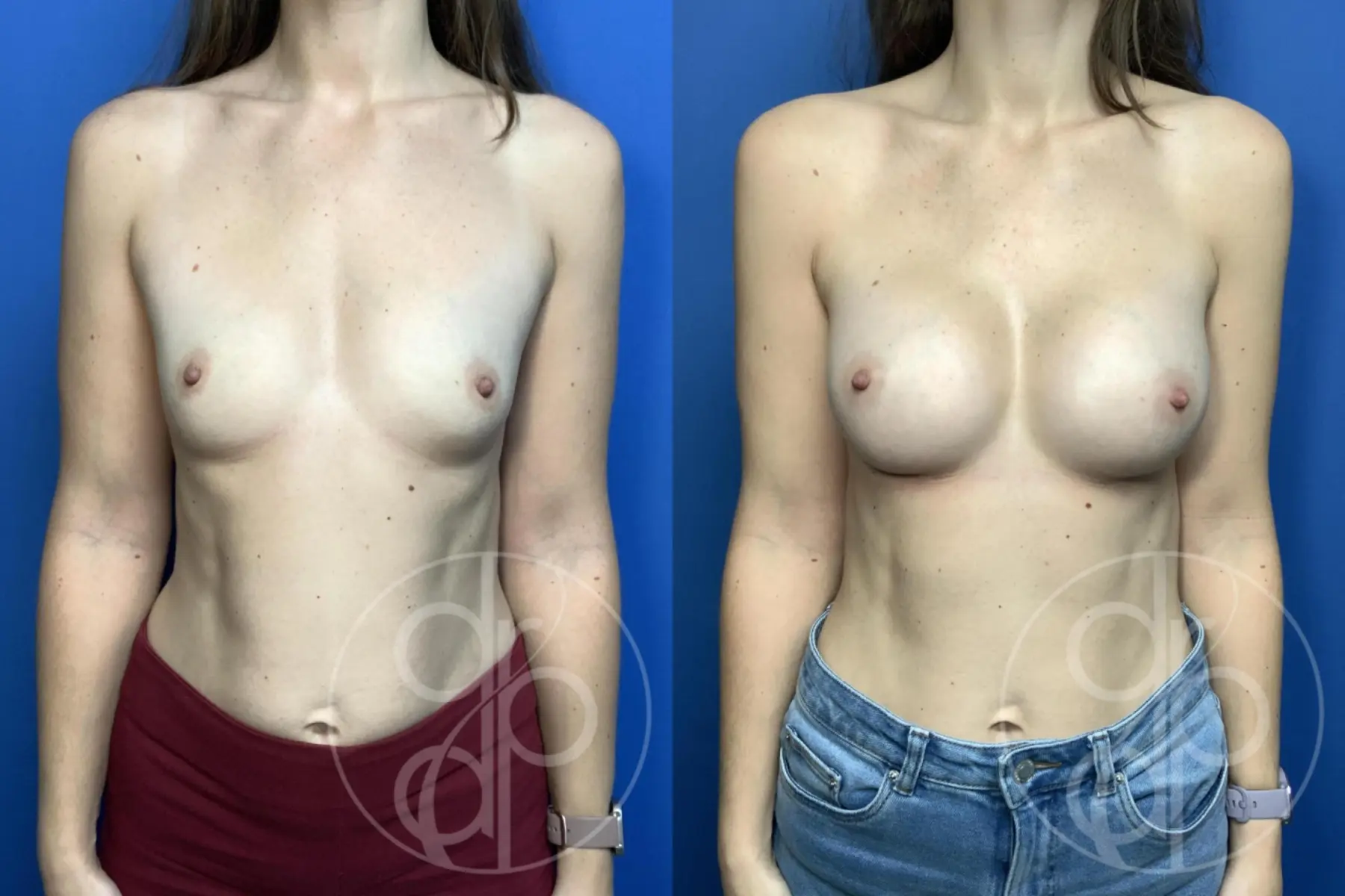 Breast Augmentation: Patient 92 - Before and After 1