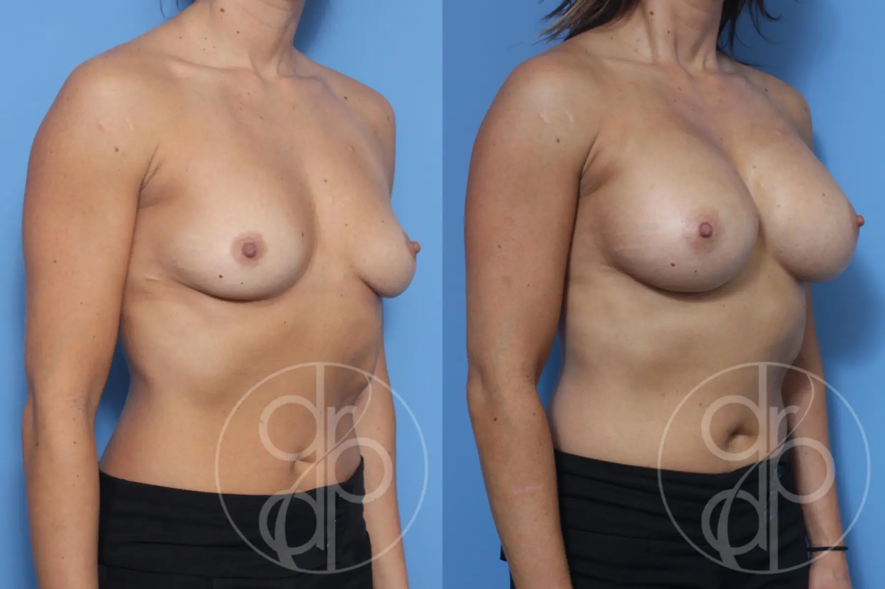 patient 13184 breast augmentation before and after result - Before and After 3