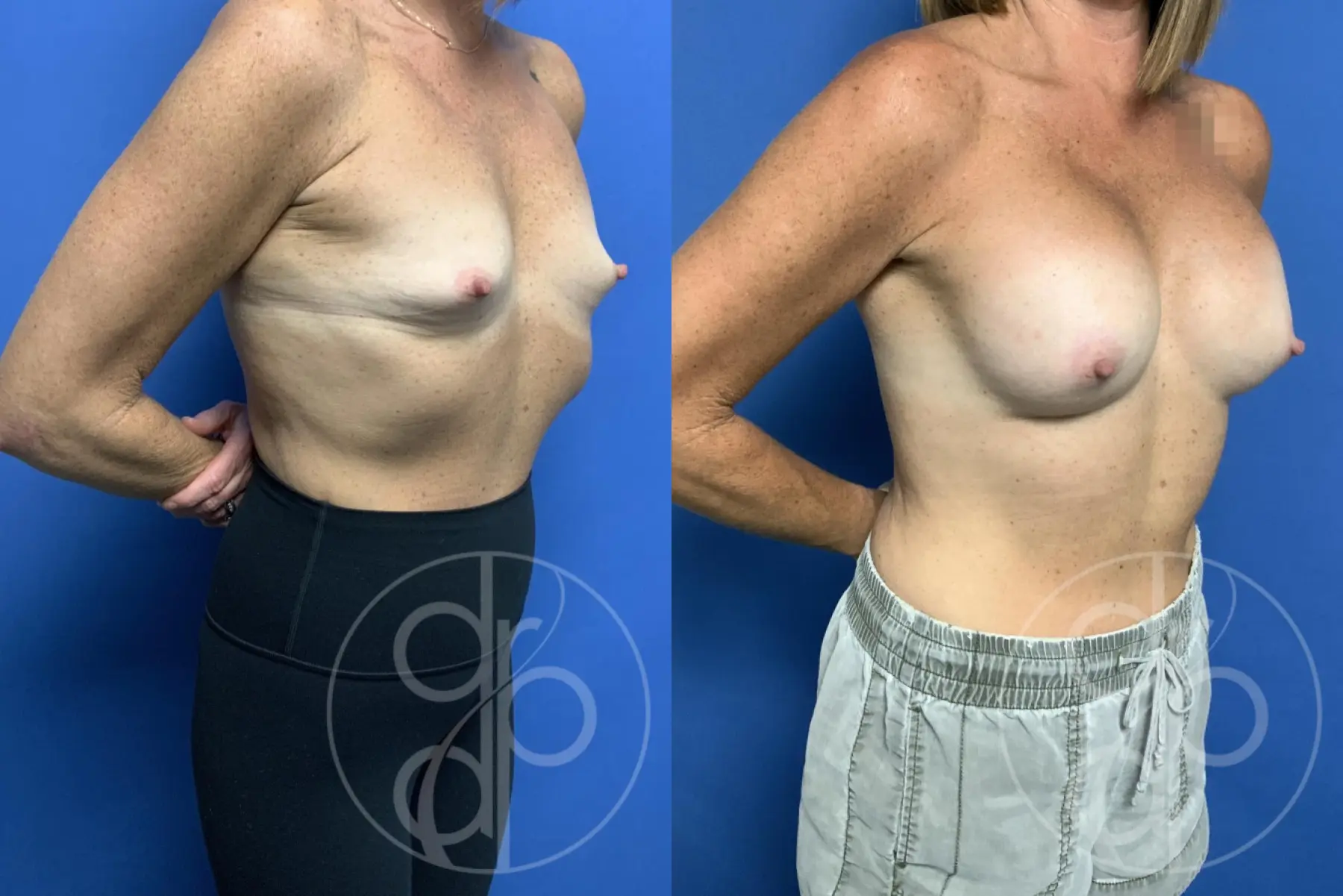 patient 13396 breast augmentation before and after result - Before and After 2