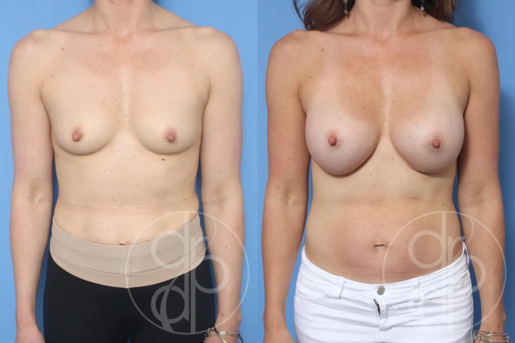 patient 10587 breast augmentation before and after result - Before and After 1
