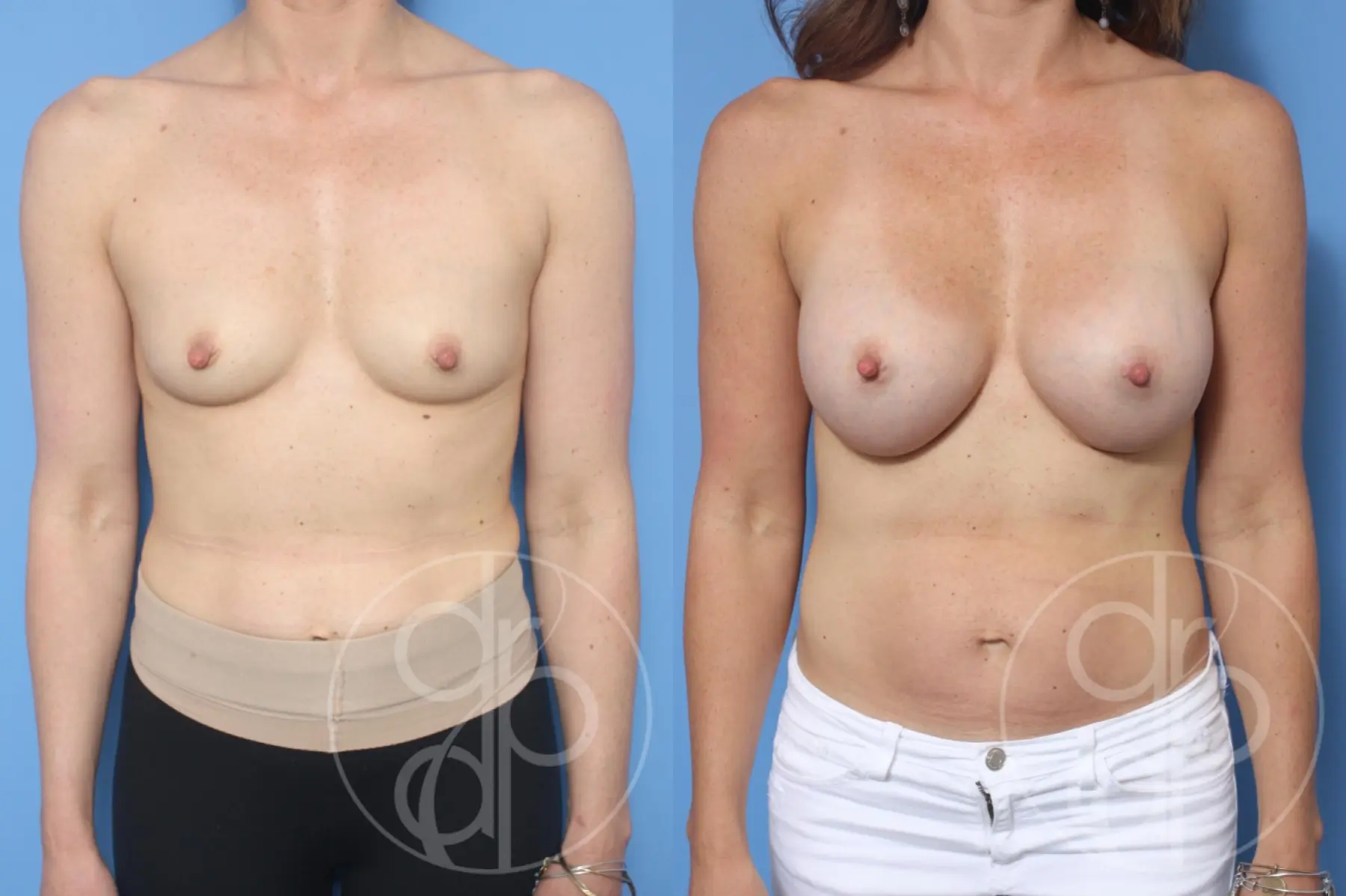 patient 10587 breast augmentation before and after result - Before and After