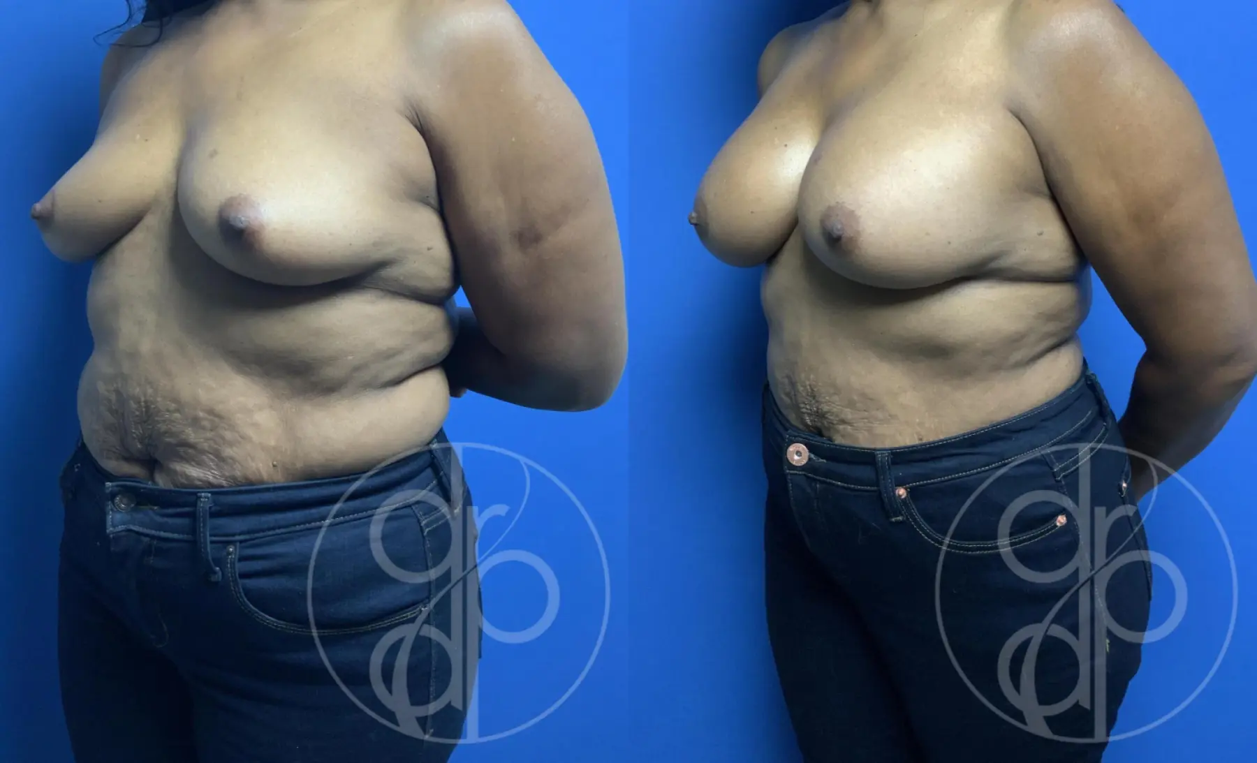 patient 12345 breast augmentation before and after result - Before and After 3