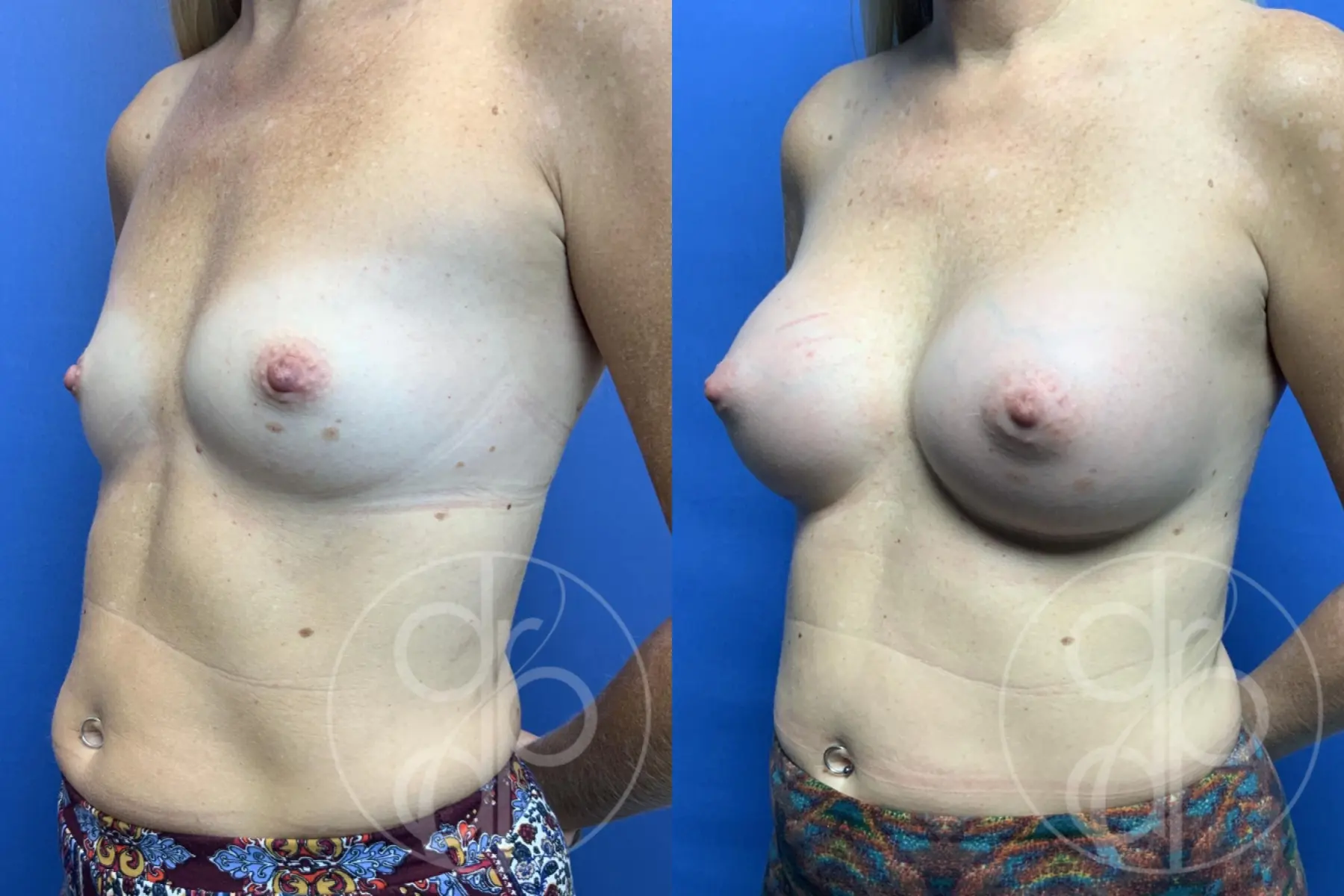 patient 10644 breast augmentation before and after result - Before and After 3