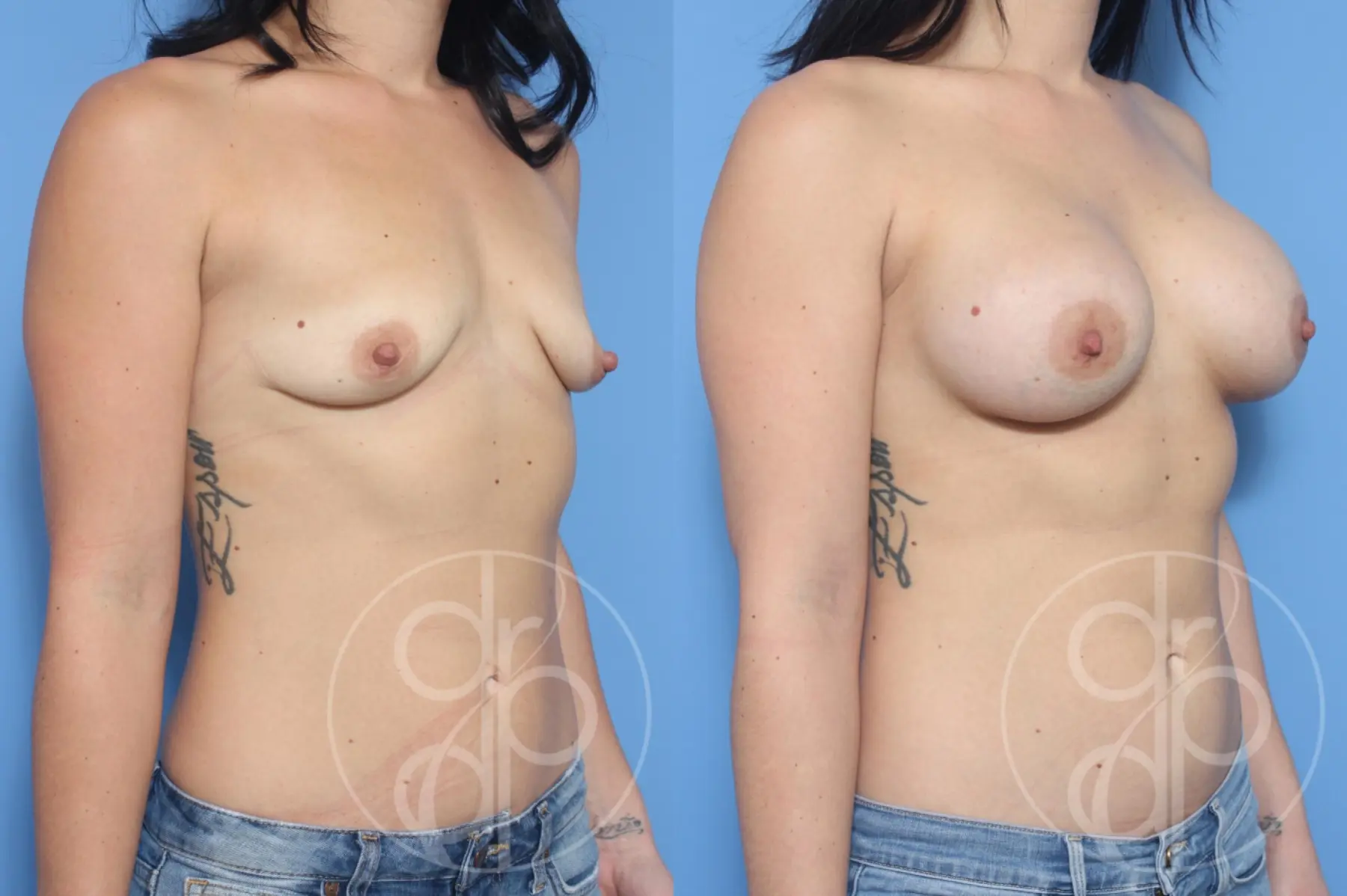 patient 13035 breast augmentation before and after result - Before and After 3