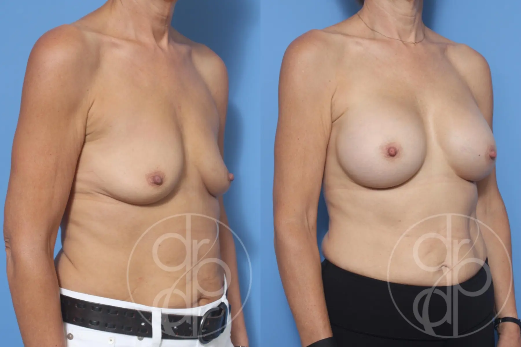 patient 10750 breast augmentation before and after result - Before and After 2