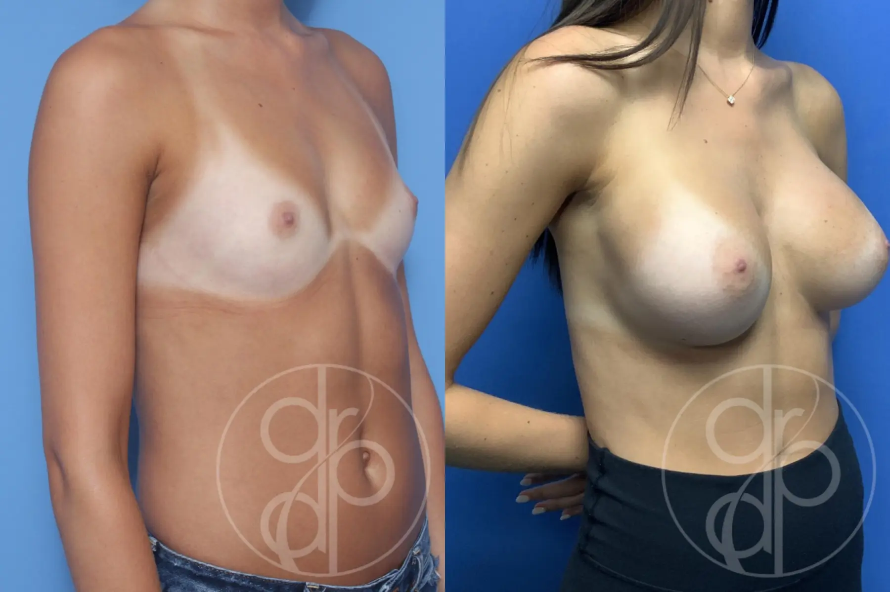 patient 12441 breast augmentation before and after result - Before and After 3