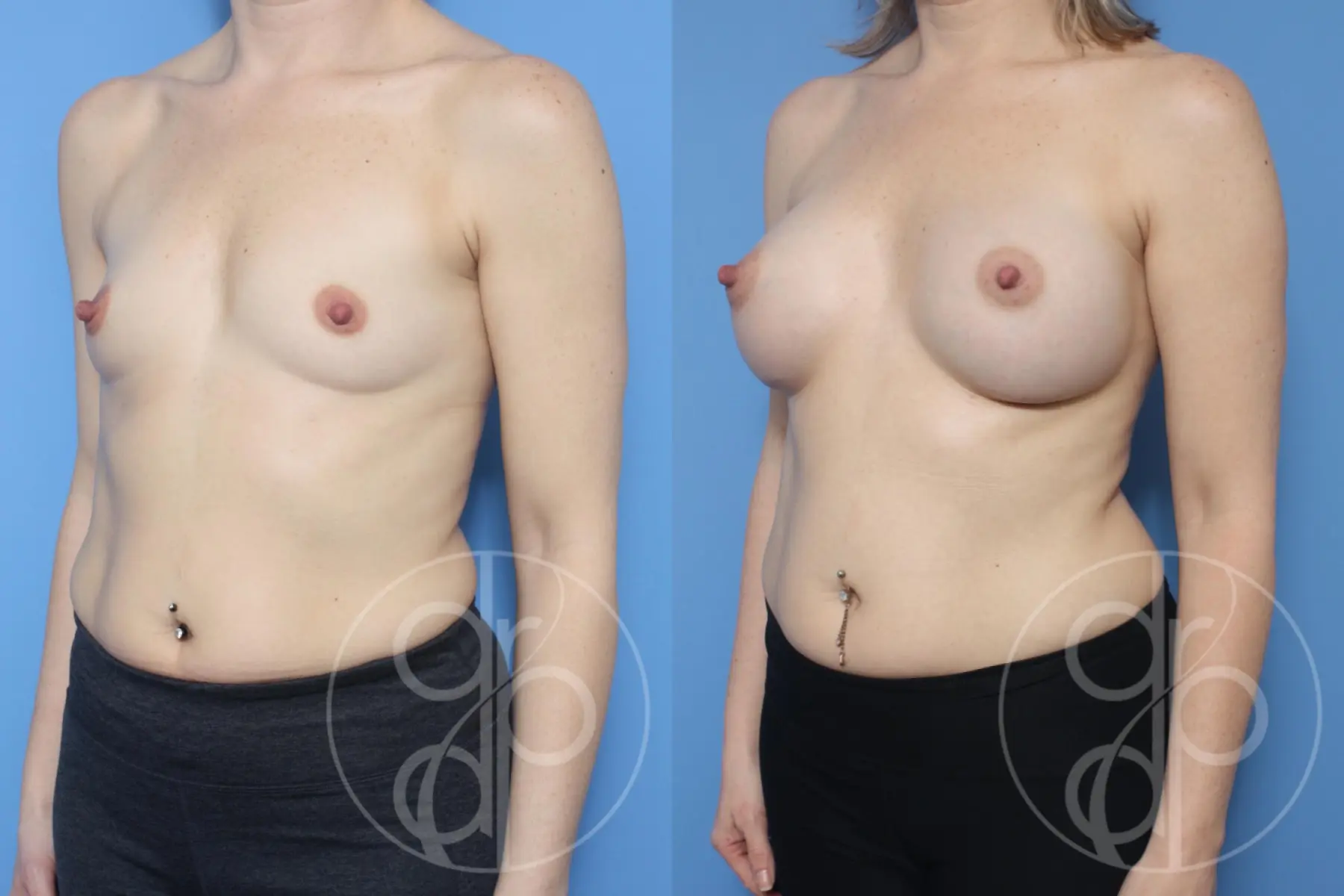 patient 14159 breast augmentation before and after result - Before and After 3