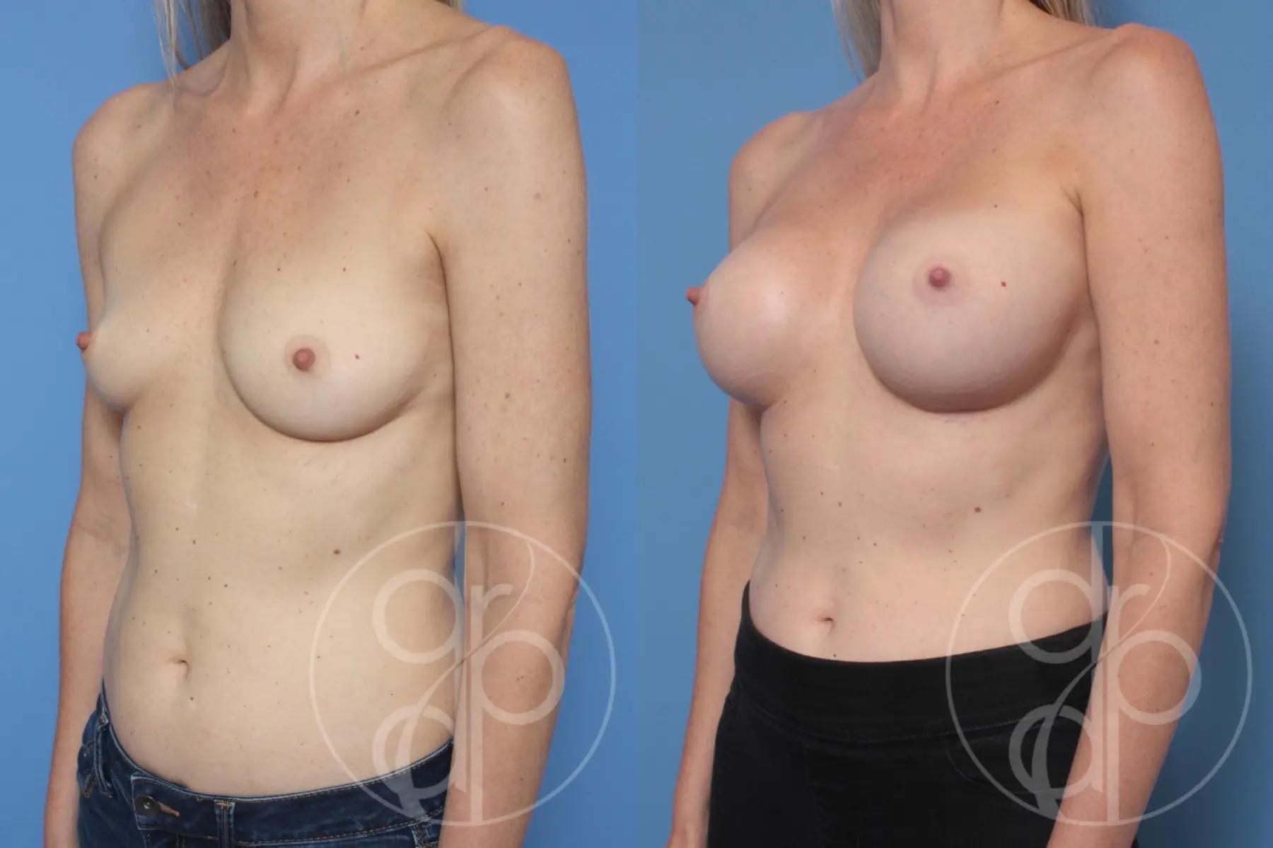 patient 10351 breast augmentation before and after result - Before and After 3