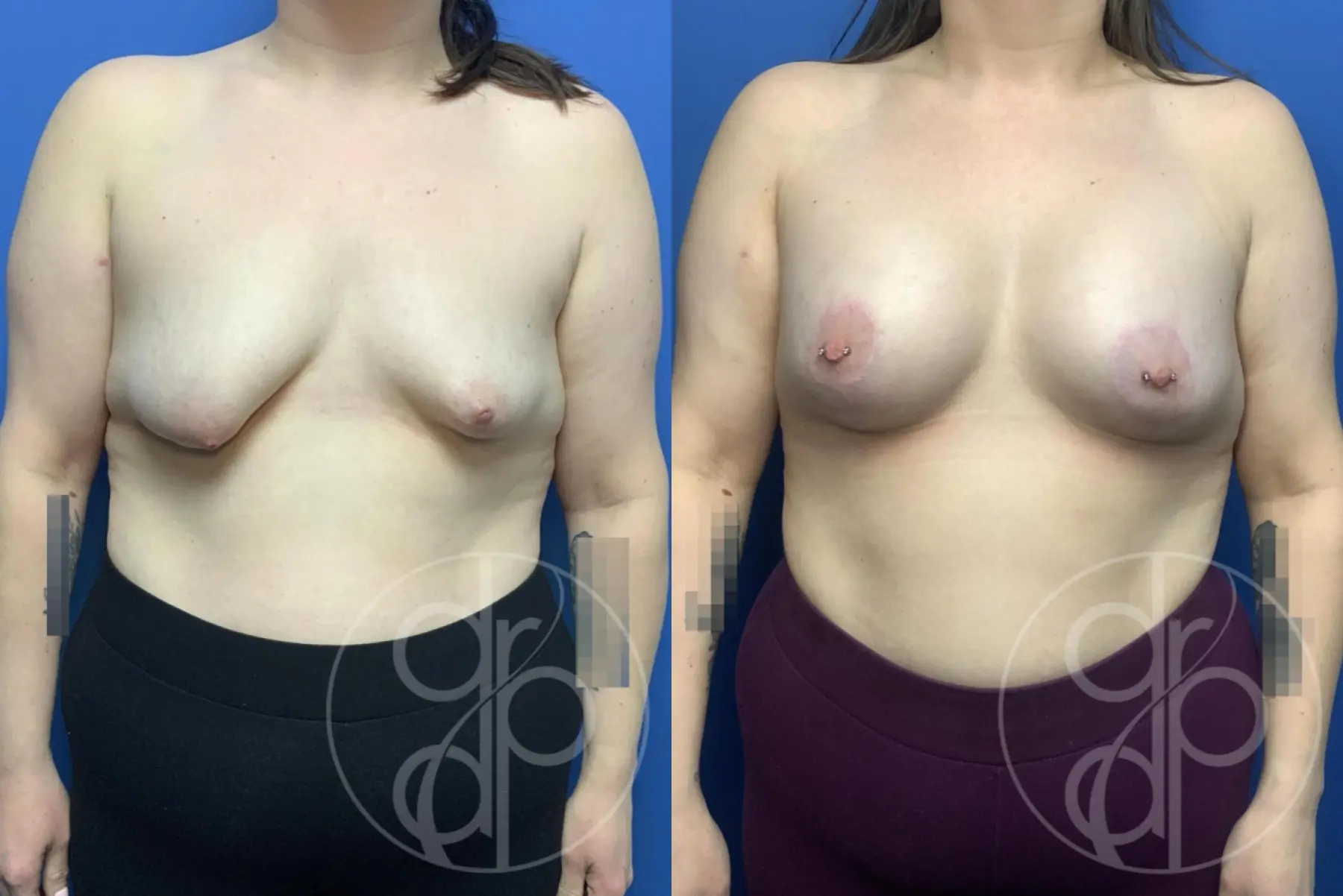 Breast Augmentation: Patient 89 - Before and After 1