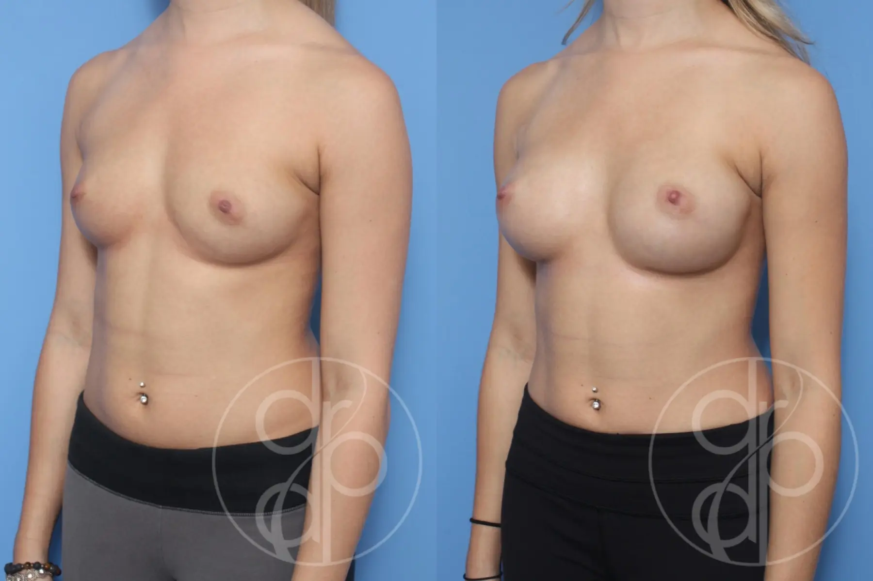 patient 12591 breast augmentation before and after result - Before and After 3