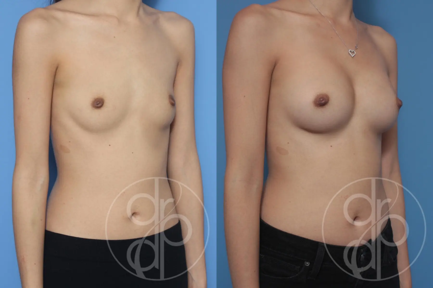 patient 10532 breast augmentation before and after result - Before and After 3