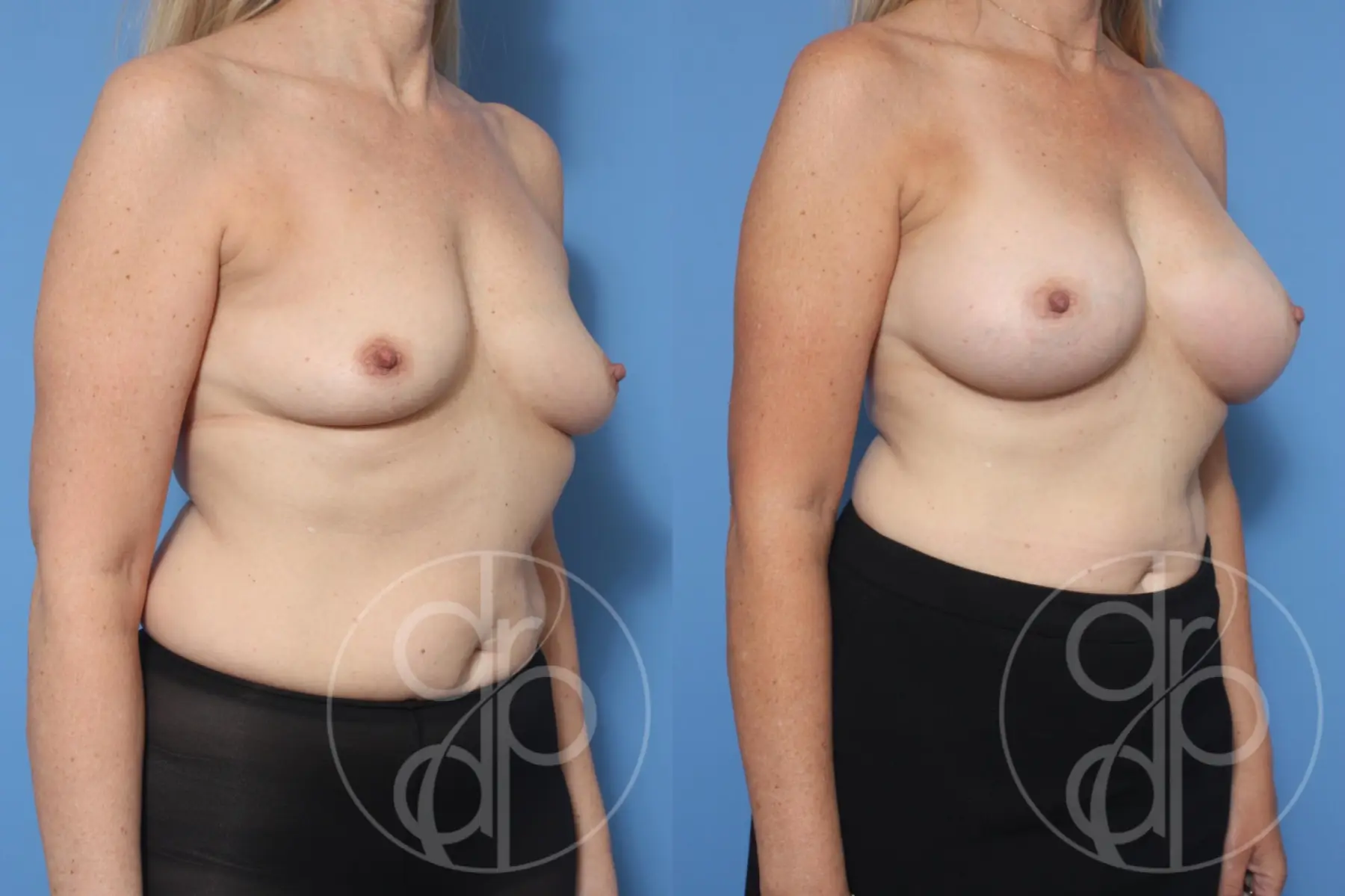 patient 12085 breast augmentation before and after result - Before and After 3