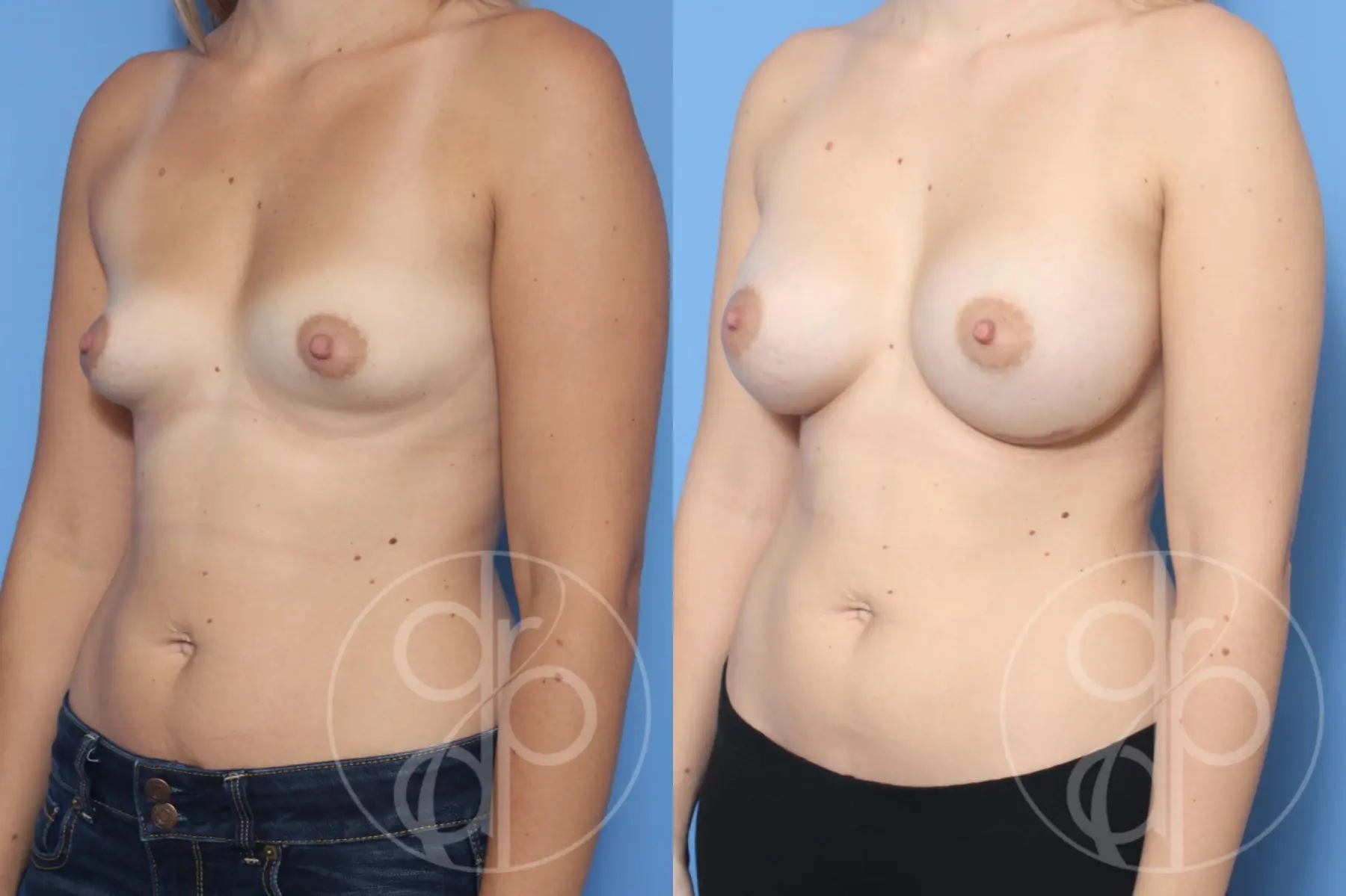 patient 12528 breast augmentation before and after result - Before and After 2