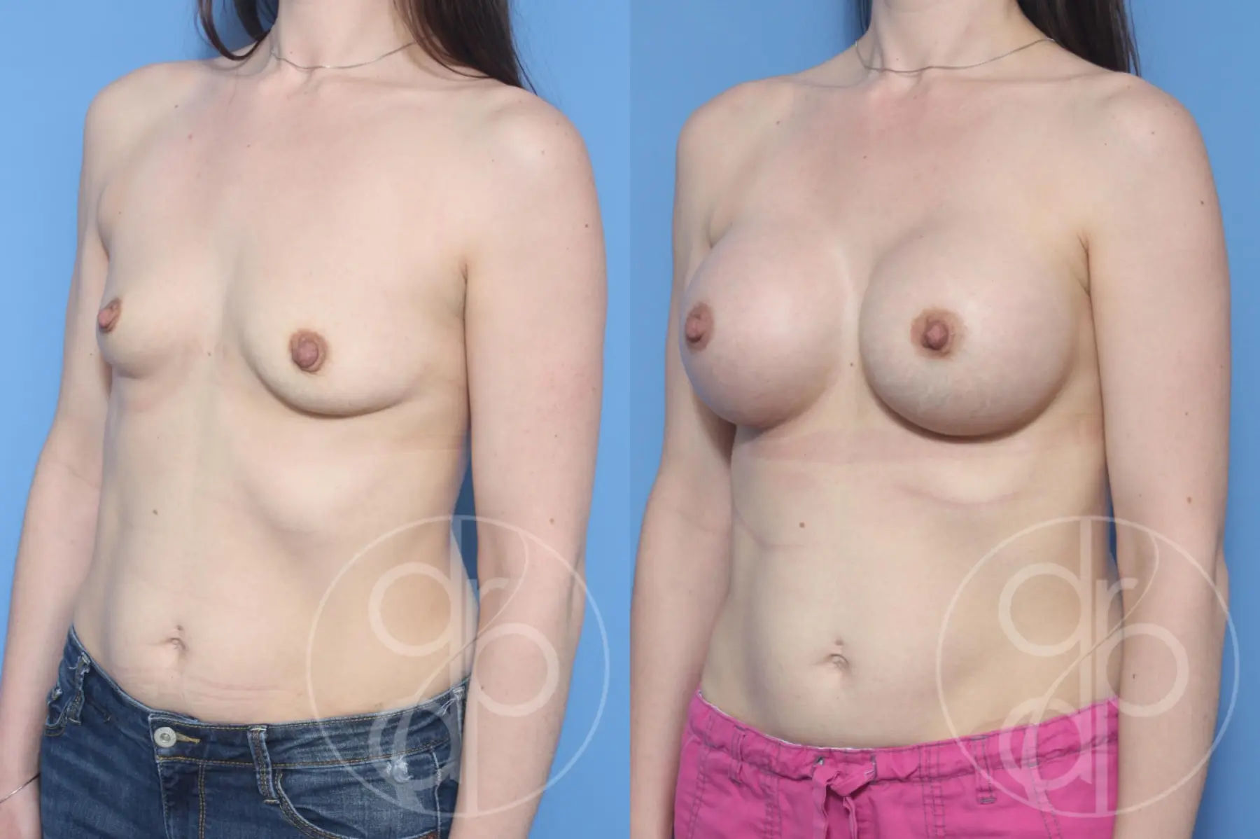 patient 13262 breast augmentation before and after result - Before and After 2