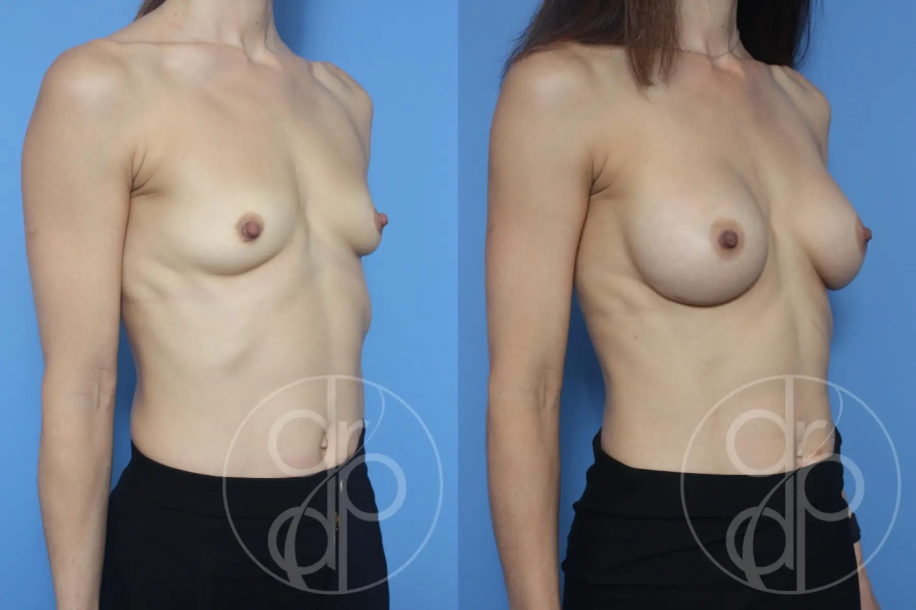 patient 10412 breast augmentation before and after result - Before and After 2