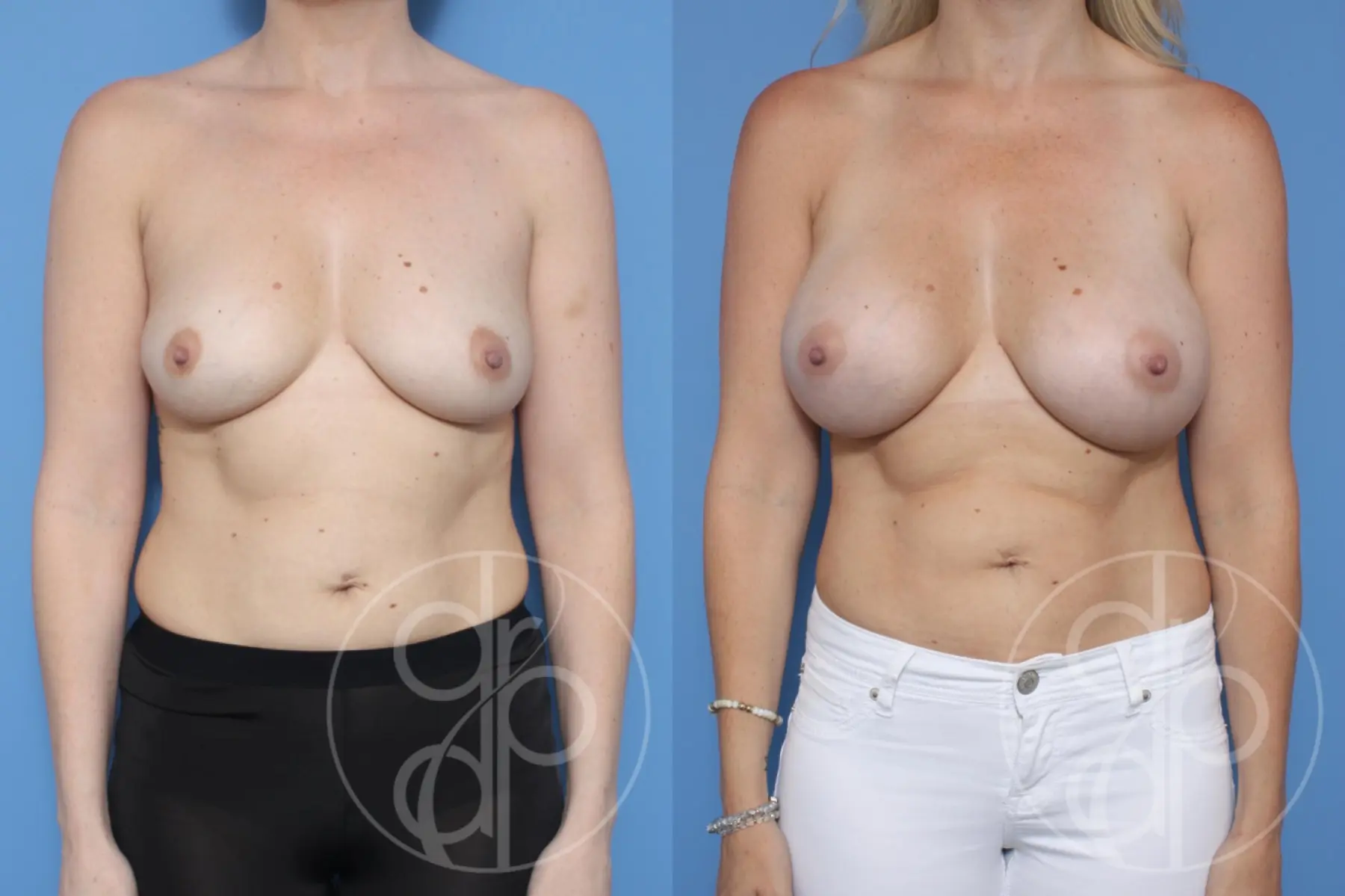 patient 10218 breast augmentation before and after result - Before and After