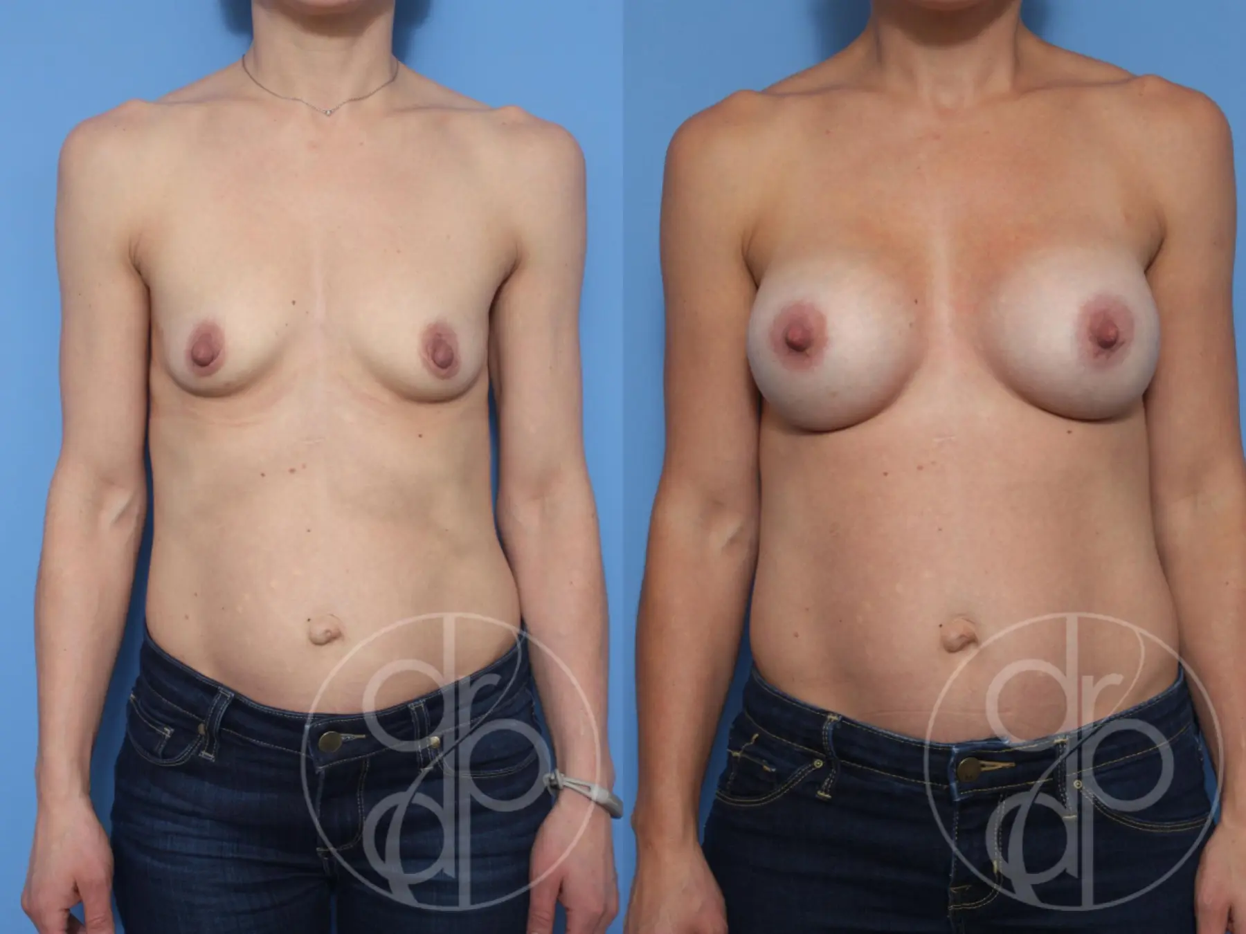 patient 13216 breast augmentation before and after result - Before and After 1