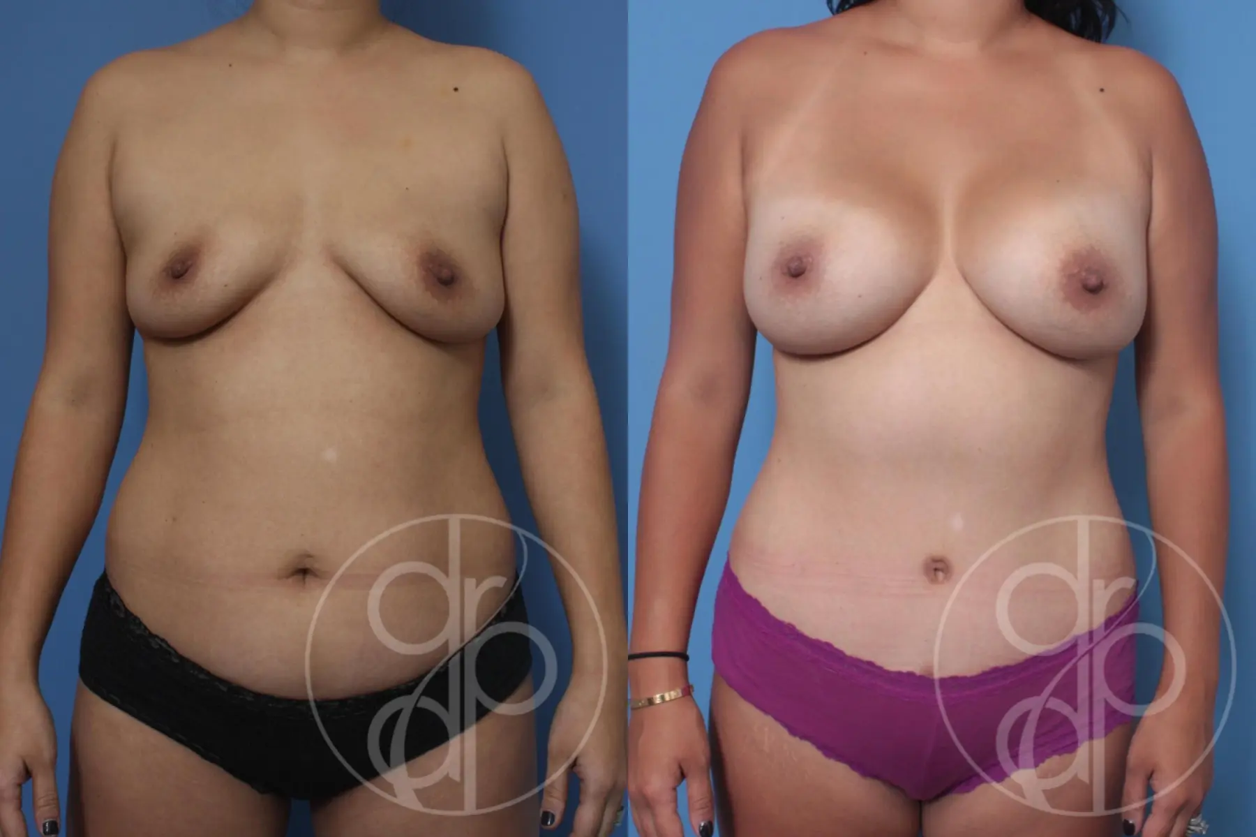 patient 10614 mommy makeover before and after result - Before and After
