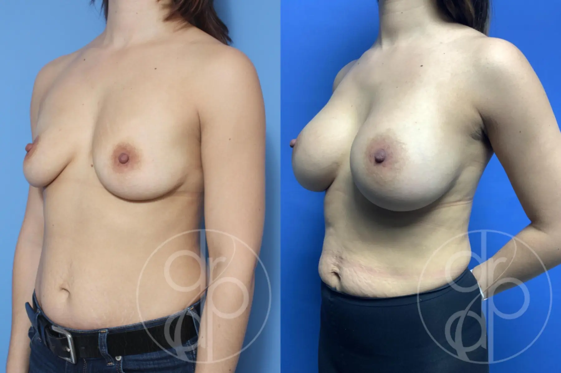 patient 10291 breast augmentation before and after result - Before and After 3