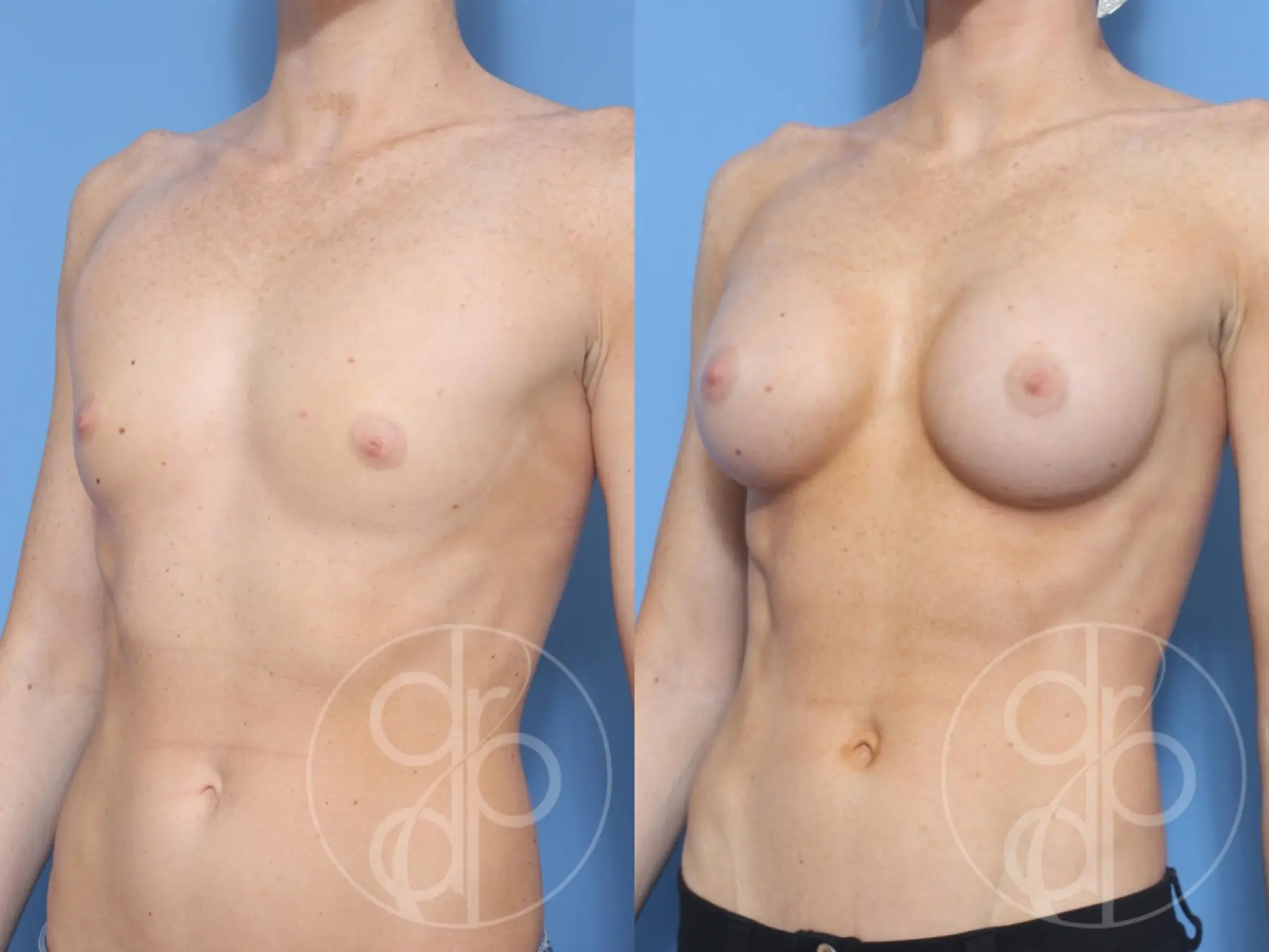patient 11885 breast augmentation before and after result - Before and After 3