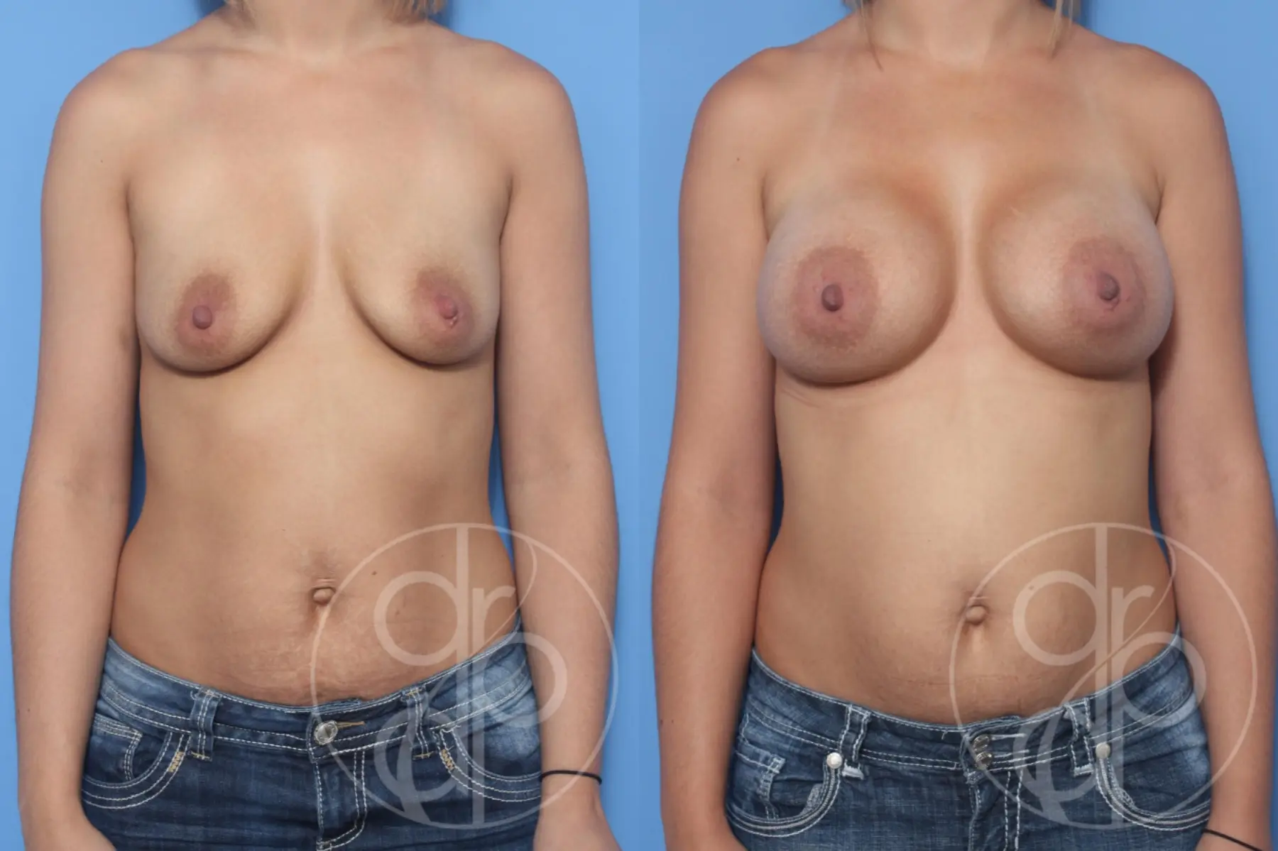 patient 13280 breast augmentation before and after result - Before and After 1
