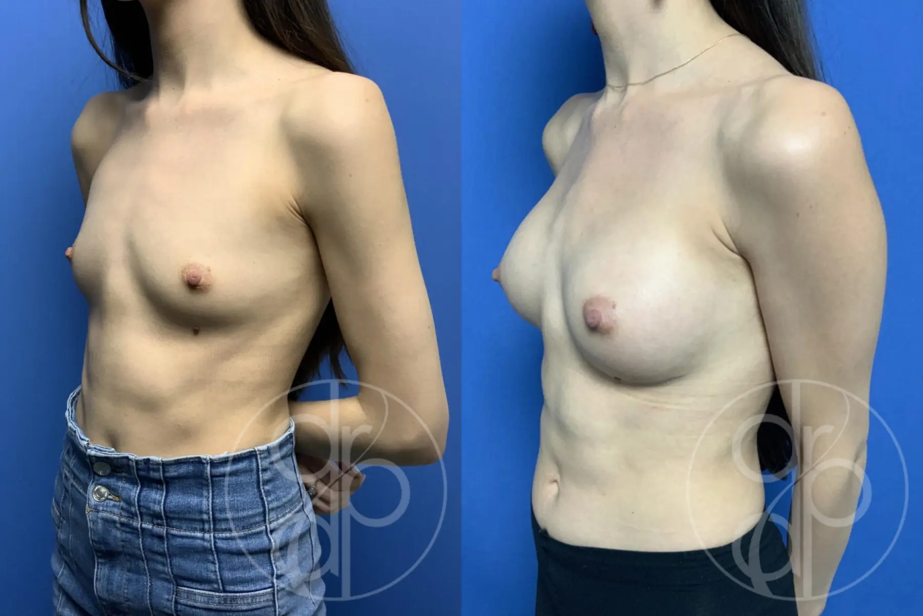 patient 13542 breast augmentation before and after result - Before and After 3