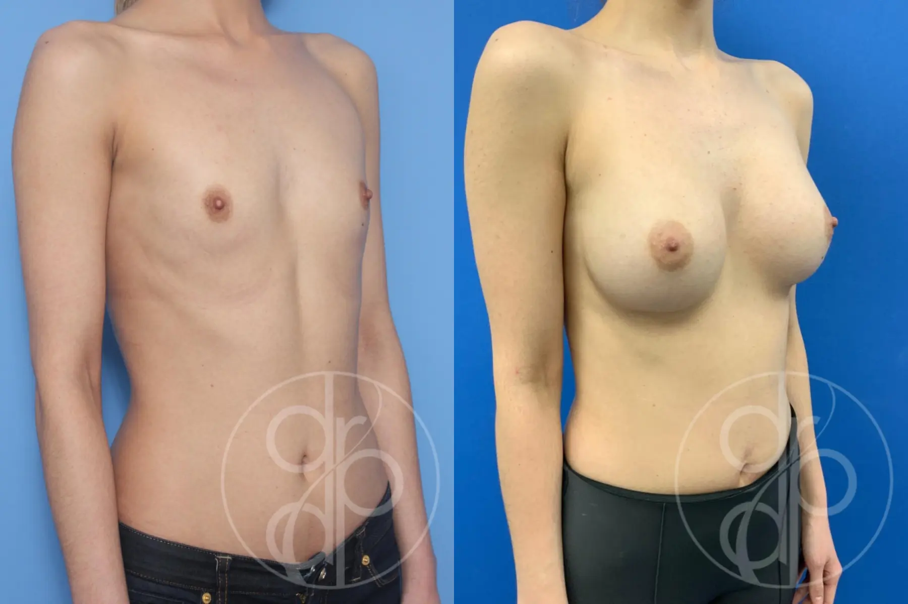 patient 10637 breast augmentation before and after result - Before and After 2