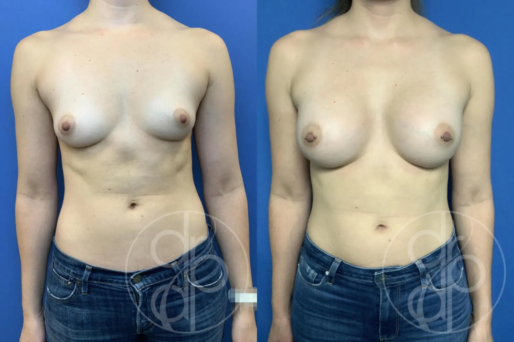 Breast Augmentation: Patient 90 - Before and After 1