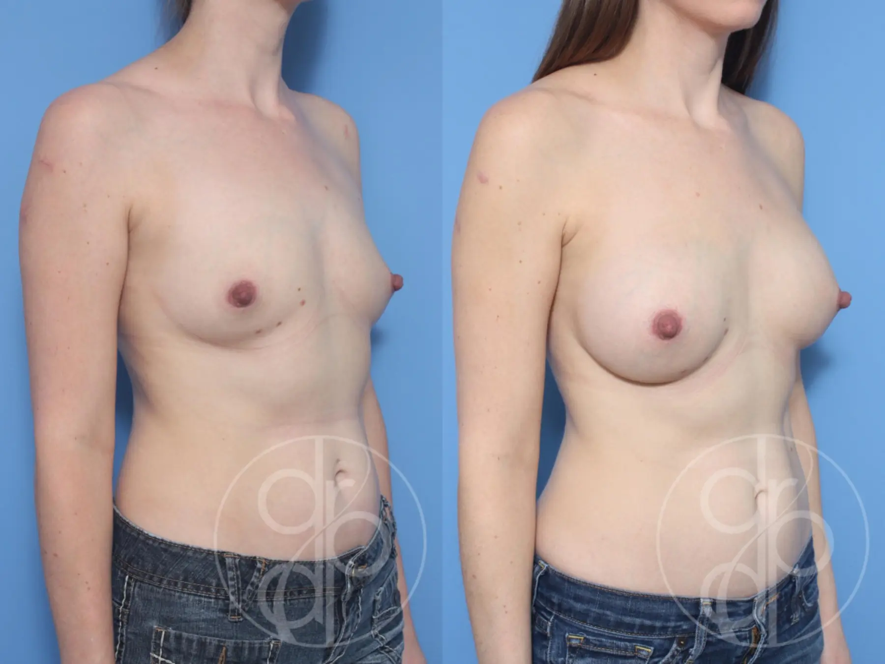 patient 10407 breast augmentation before and after result - Before and After 2