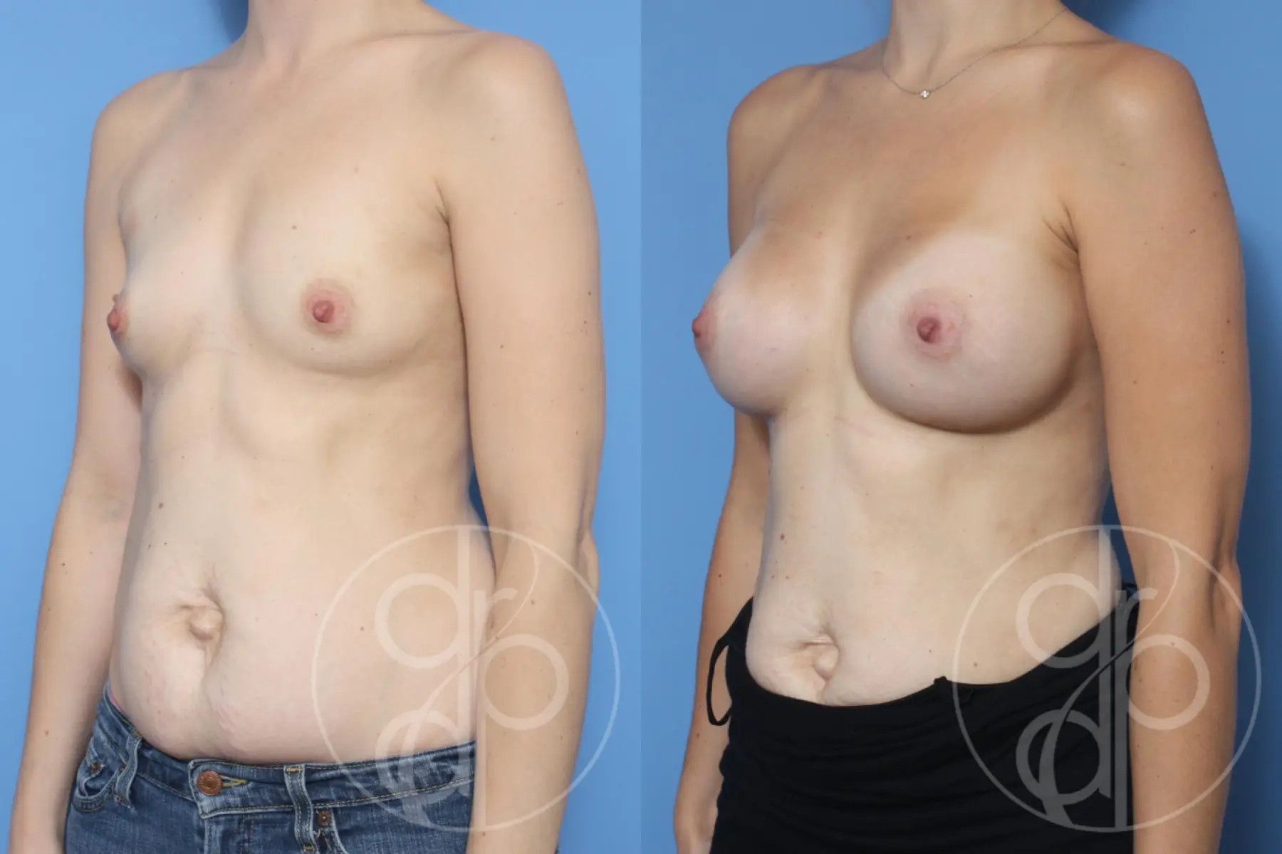 patient 13069 breast augmentation before and after result - Before and After 3