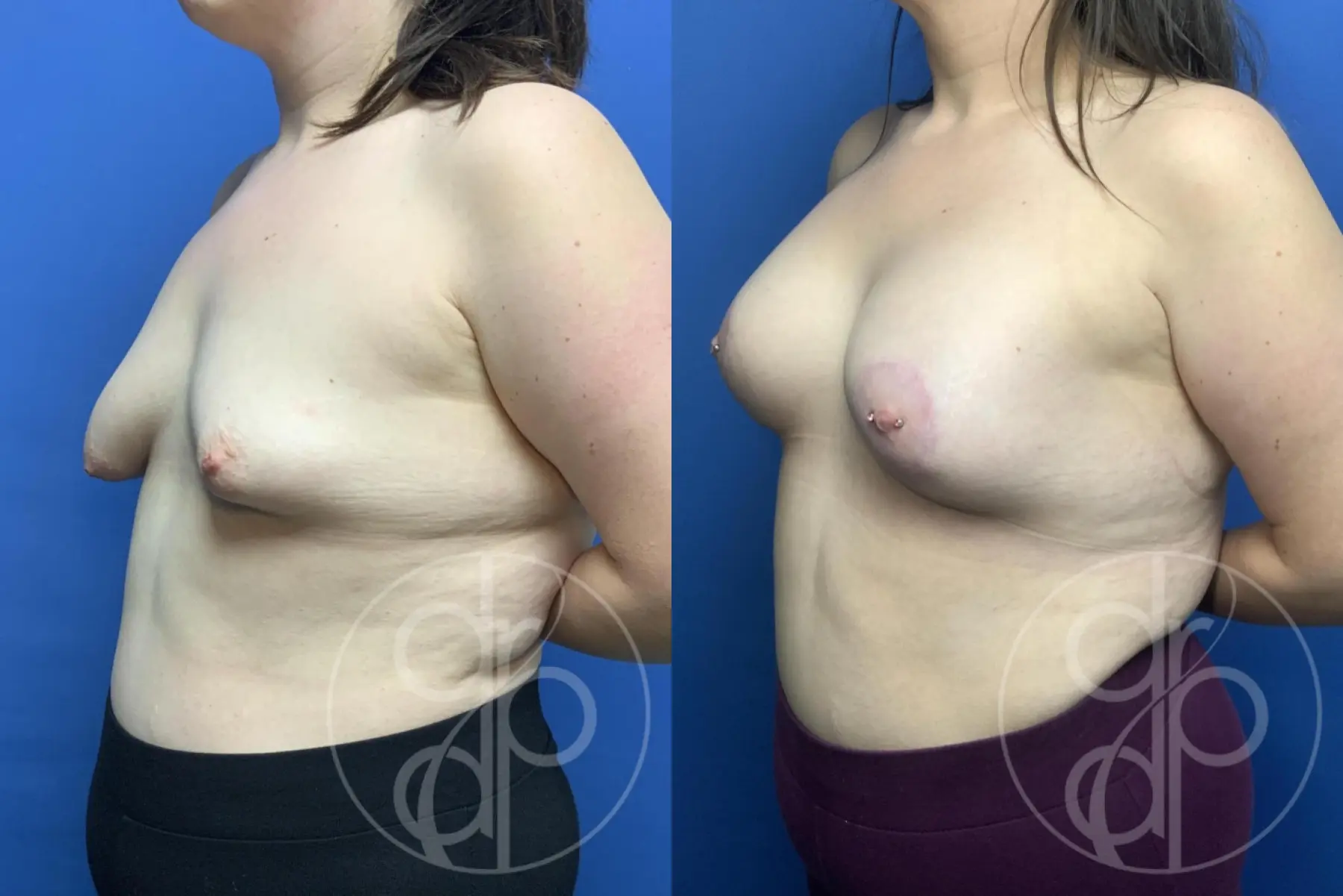 Breast Augmentation: Patient 89 - Before and After 3