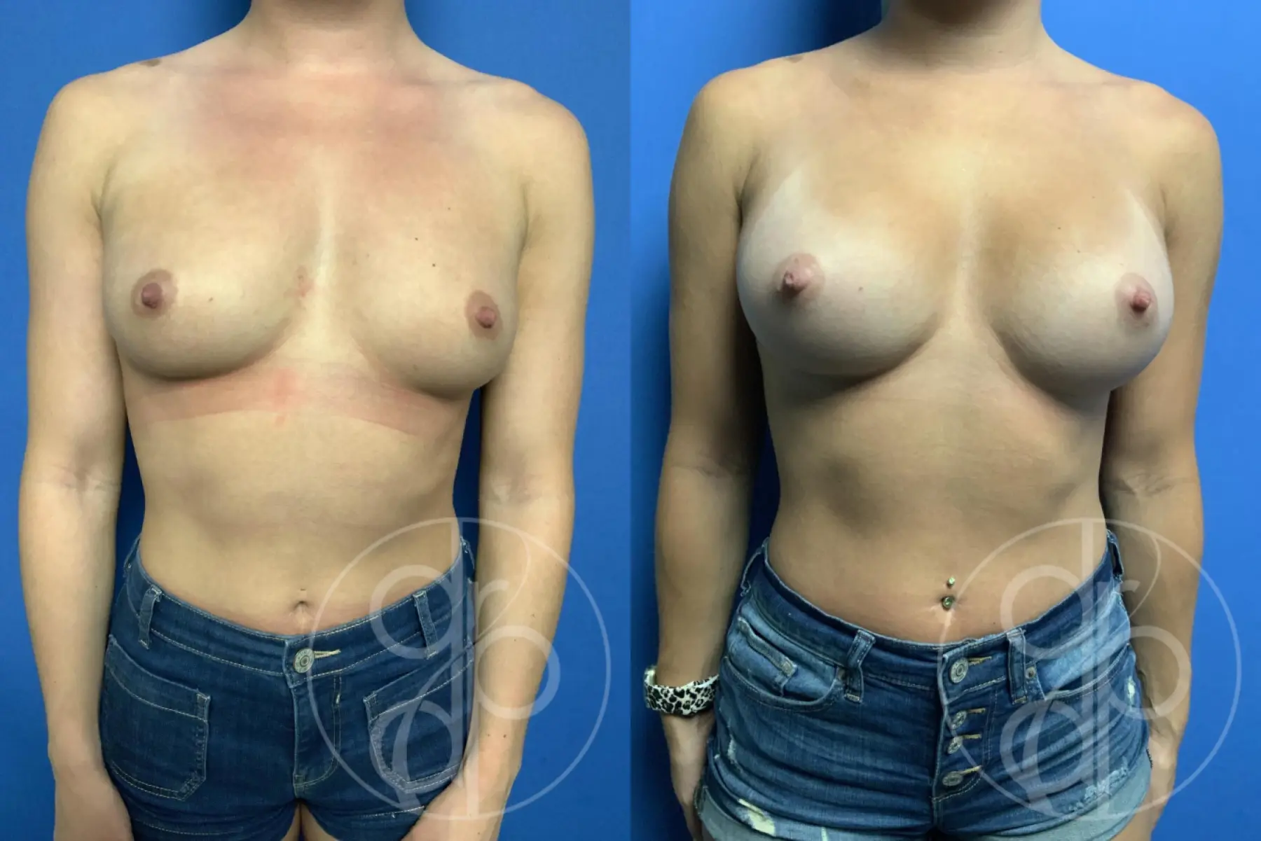 patient 12038 breast augmentation before and after result - Before and After