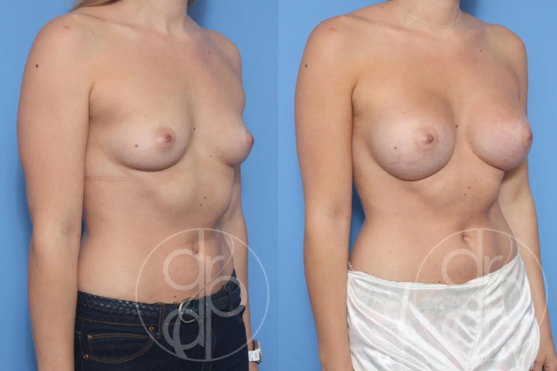 patient 14165 breast augmentation before and after result - Before and After 2