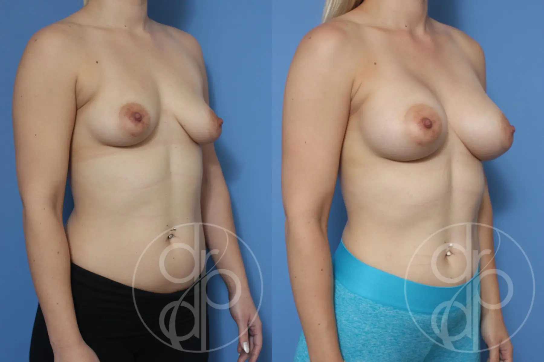 patient 10504 breast augmentation before and after result - Before and After 2