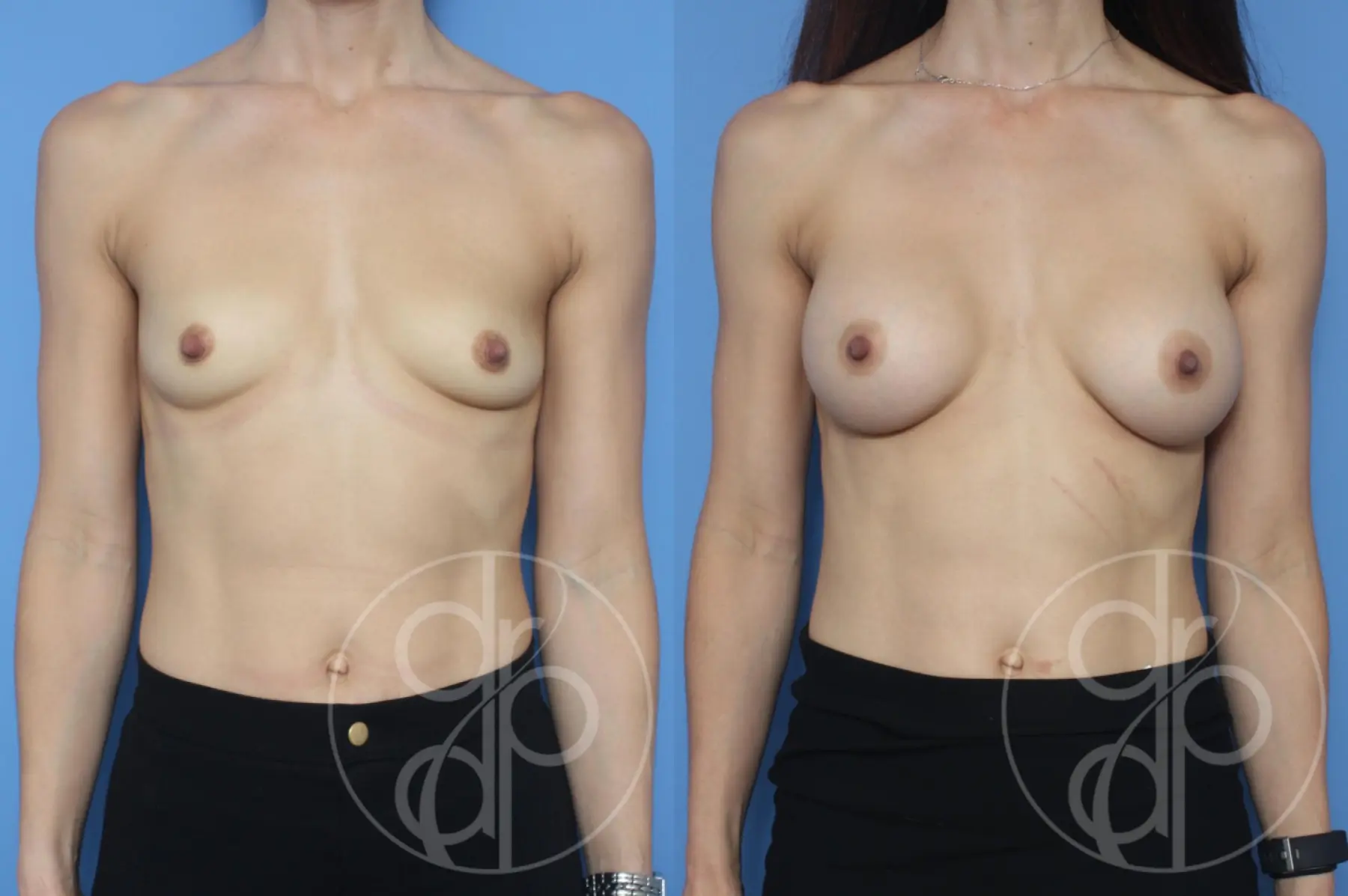 patient 10412 breast augmentation before and after result - Before and After 1