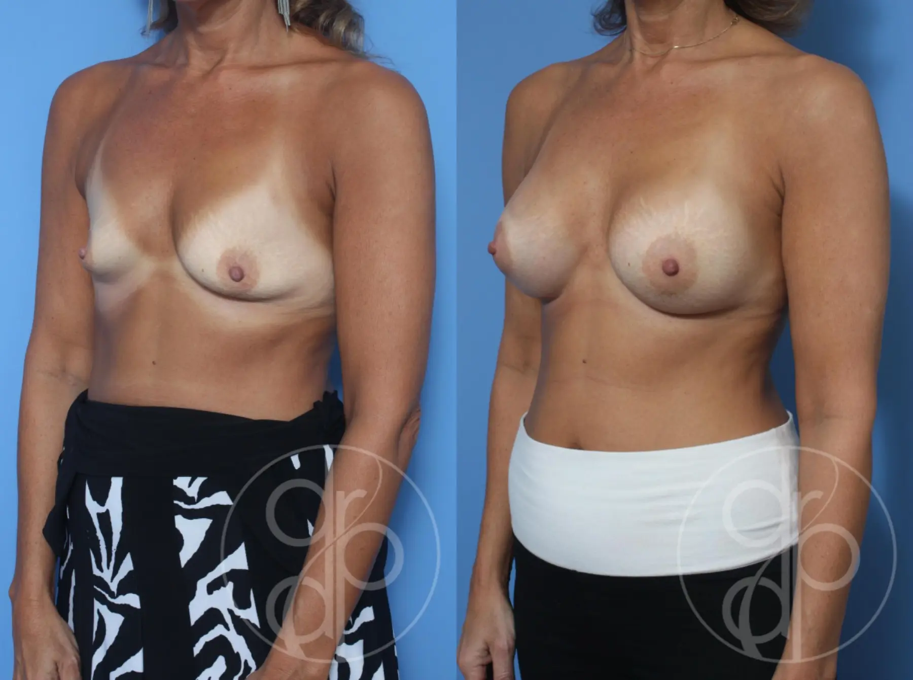 patient 13088 breast augmentation before and after result - Before and After 4