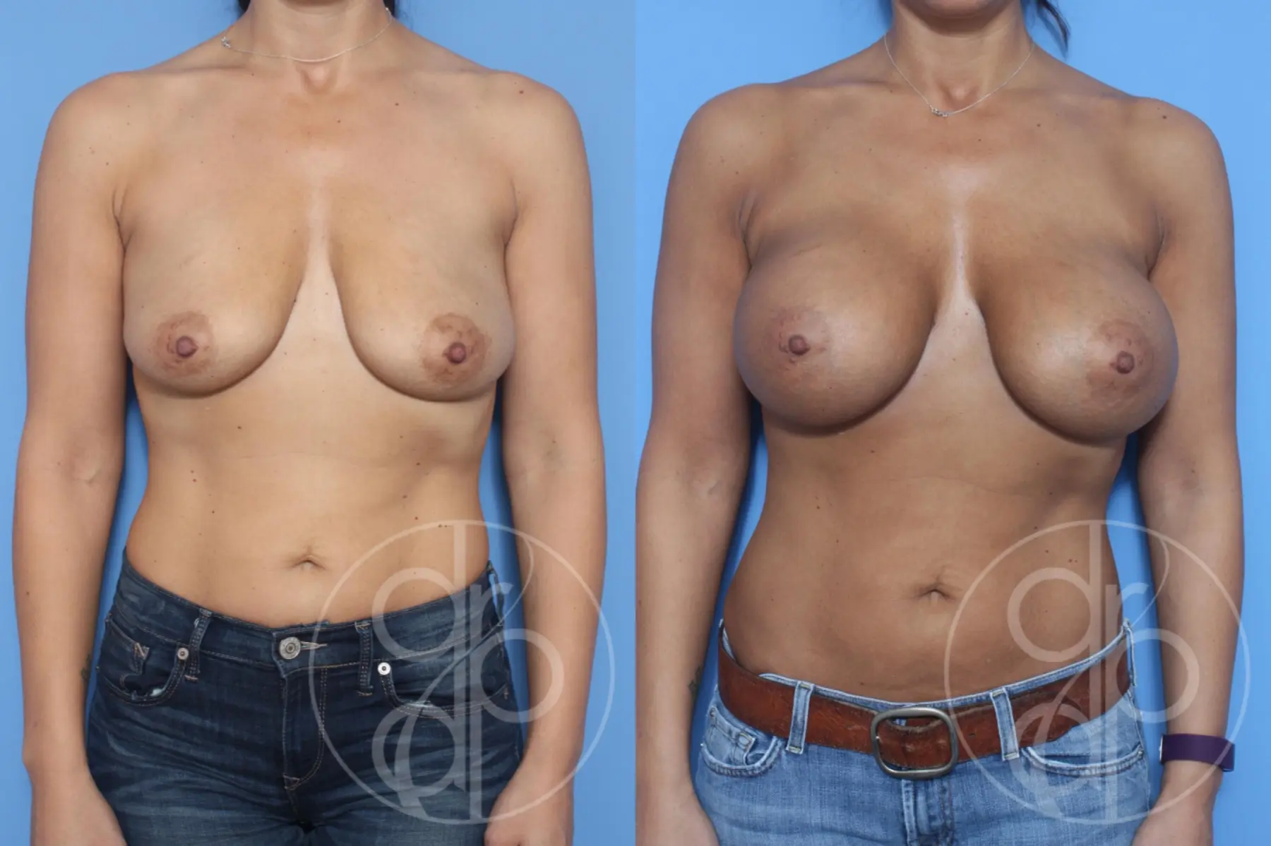 patient 10297 breast augmentation before and after result - Before and After