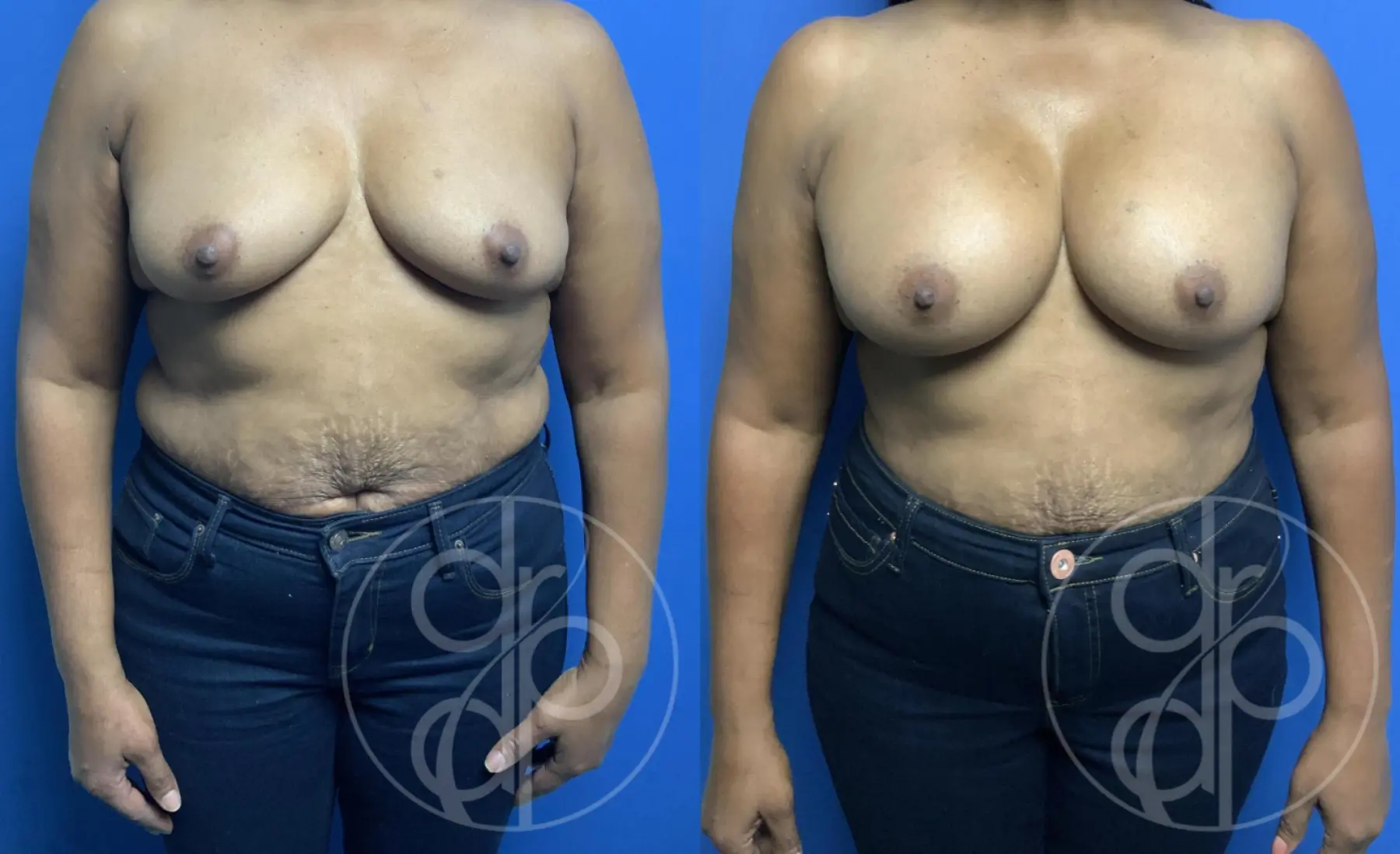 patient 12345 breast augmentation before and after result - Before and After 1