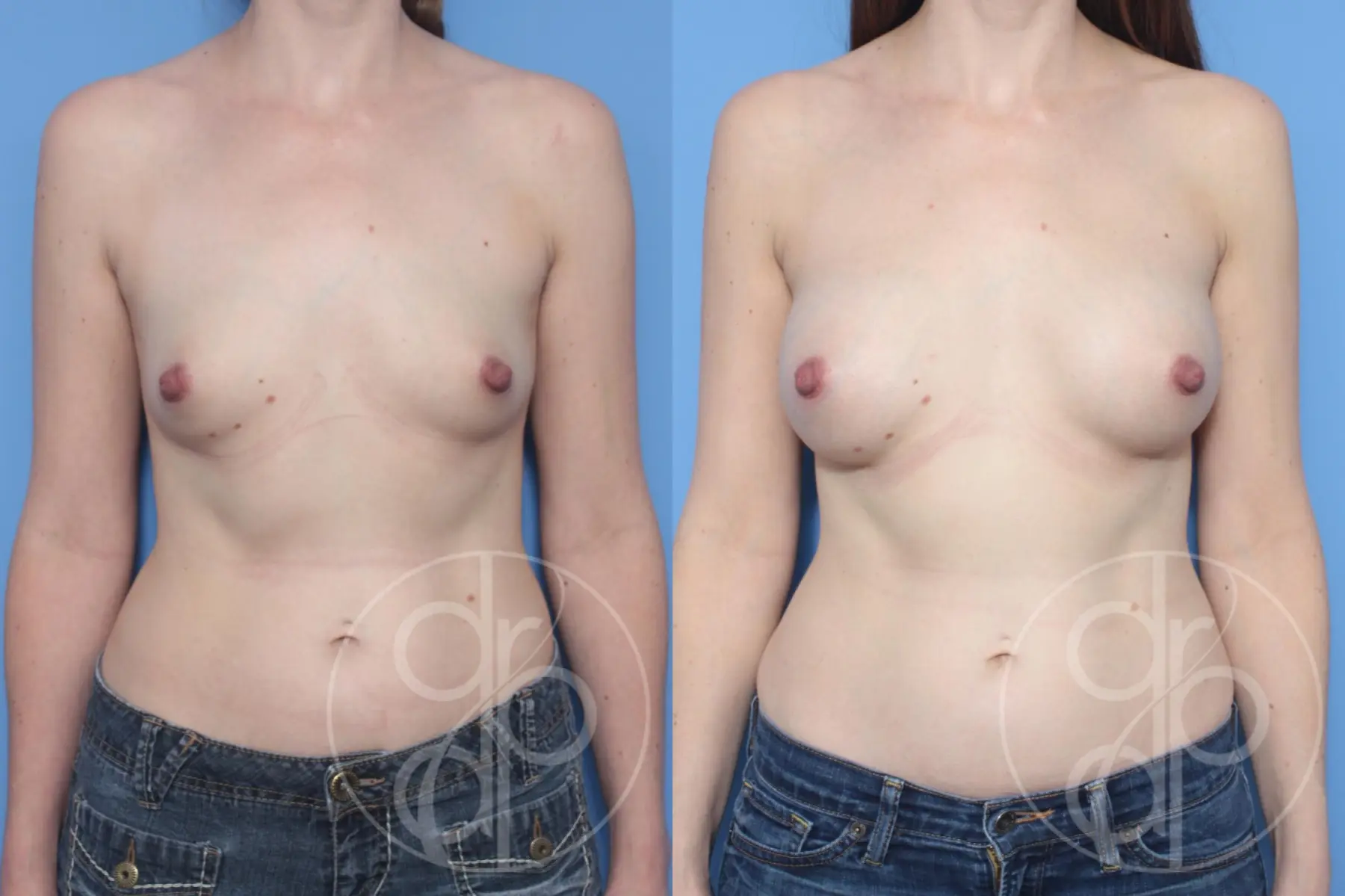 patient 10407 breast augmentation before and after result - Before and After 1