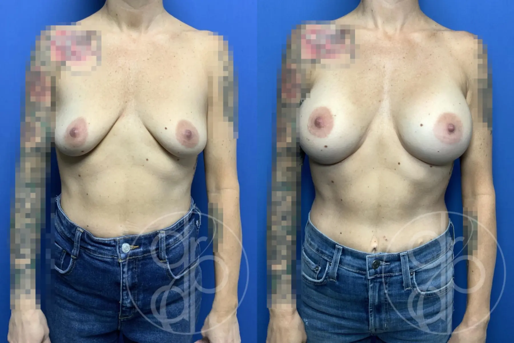 patient 13883 breast augmentation before and after result - Before and After 1