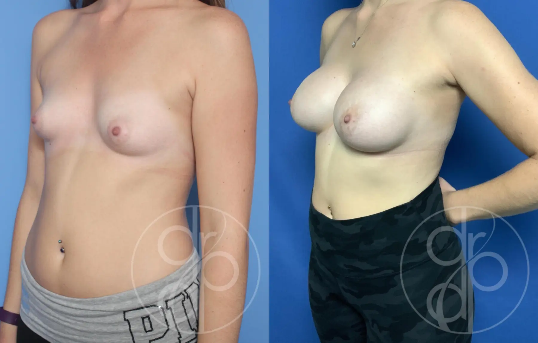 patient 10544 breast augmentation before and after result - Before and After 3
