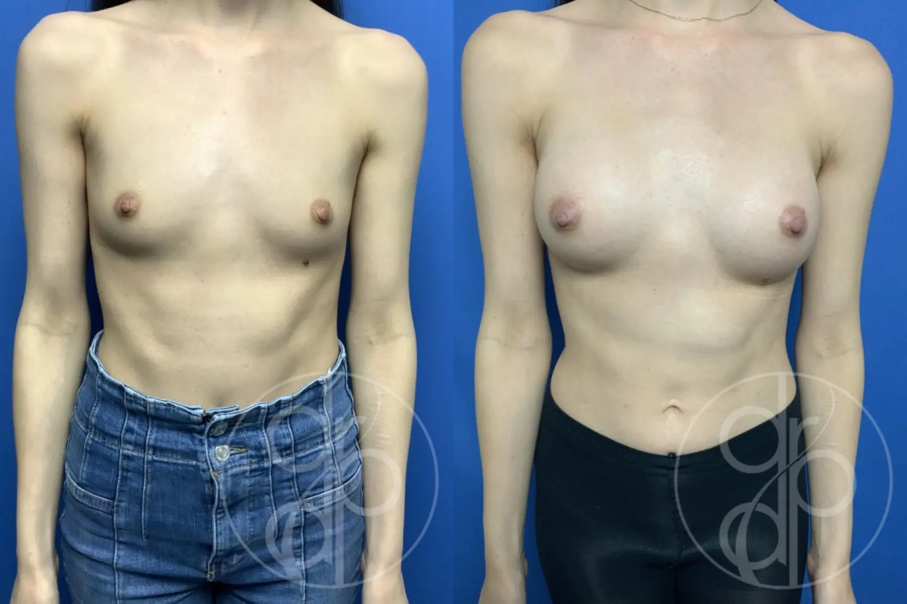 patient 13542 breast augmentation before and after result - Before and After 1