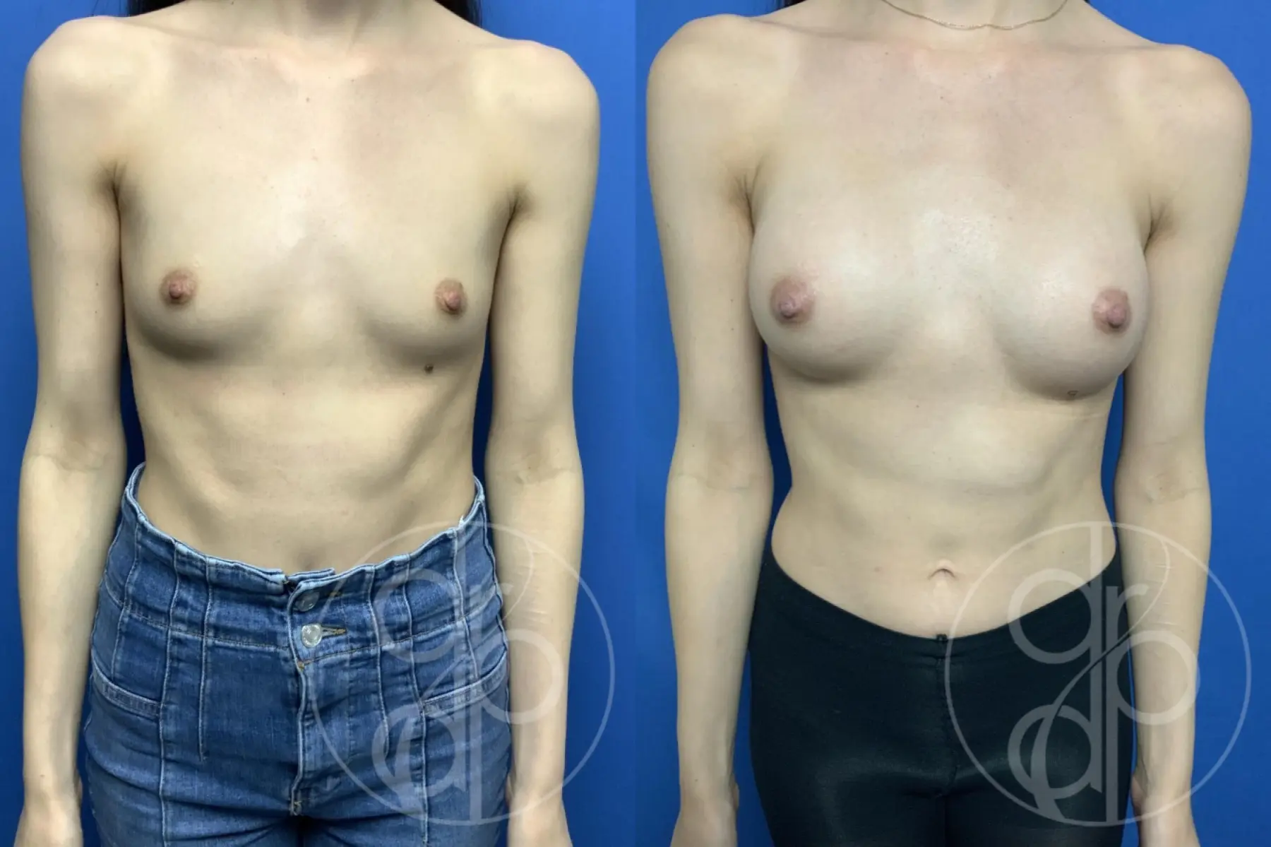 patient 13542 breast augmentation before and after result - Before and After