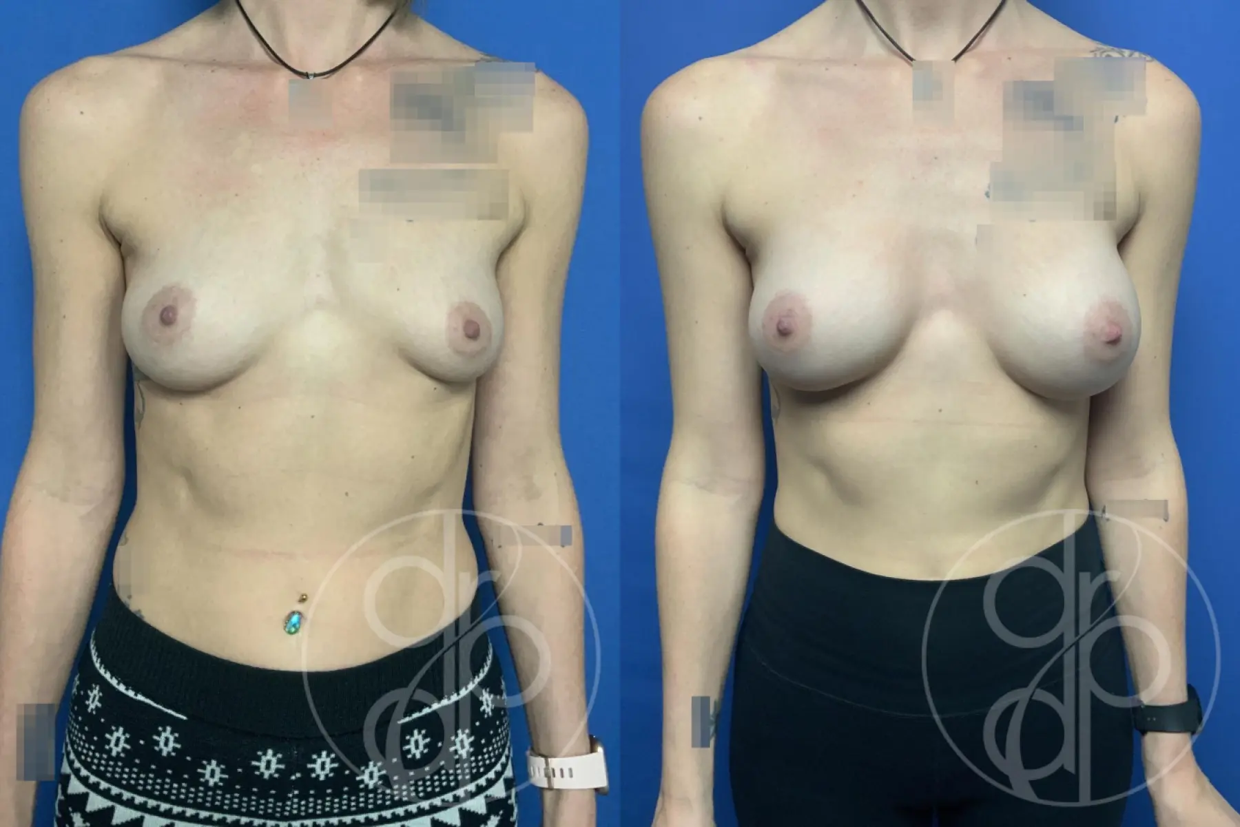 patient 12760 breast augmentation before and after result - Before and After 1